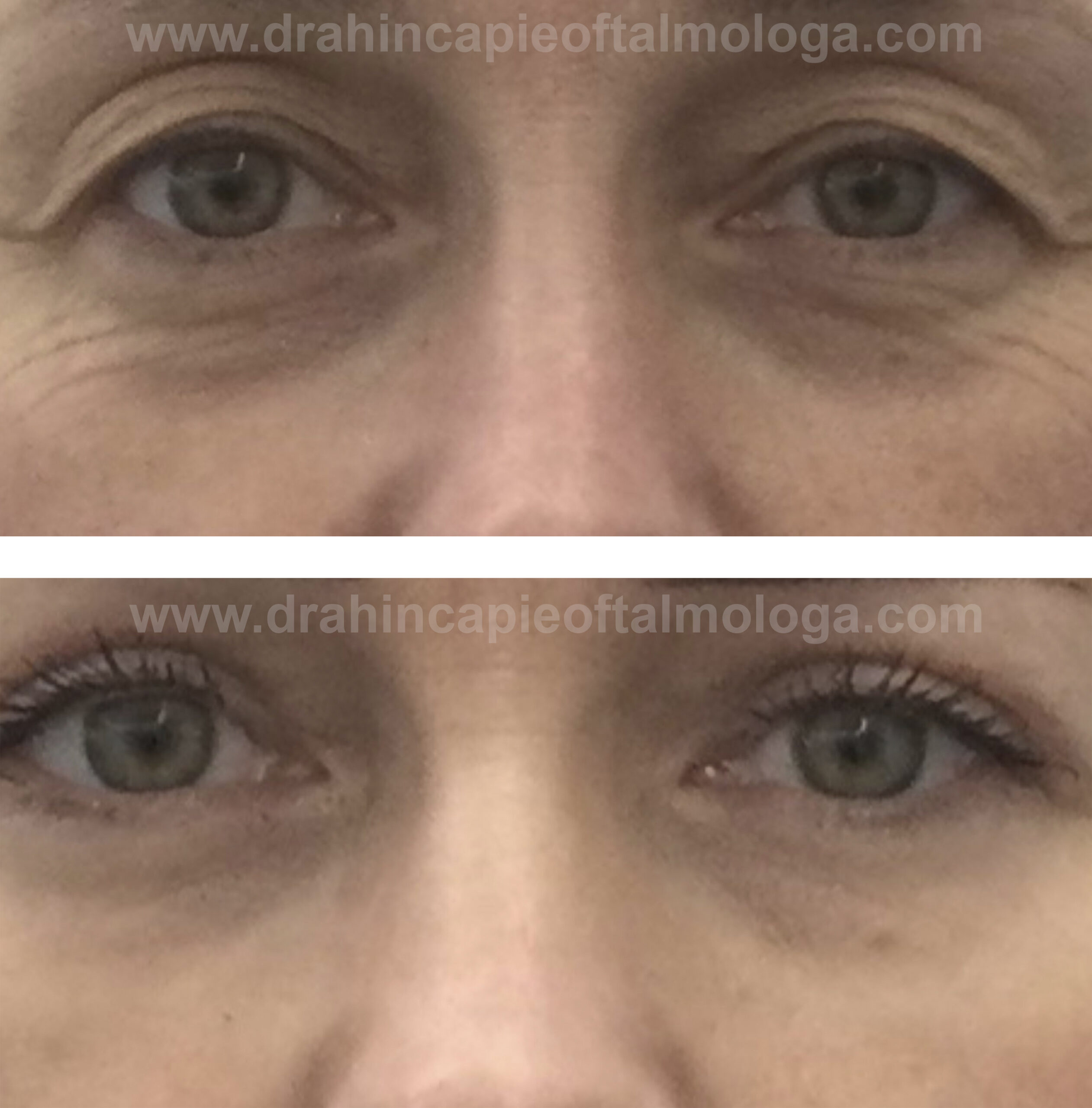 Blefaroplastia