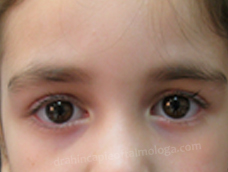 1 mes Postoperatorio Corrección Ptosis palpebral congénita OD