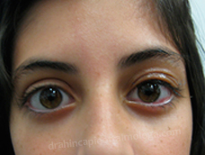 15 dias Postoperatorio Corrección ptosis palpebral OI