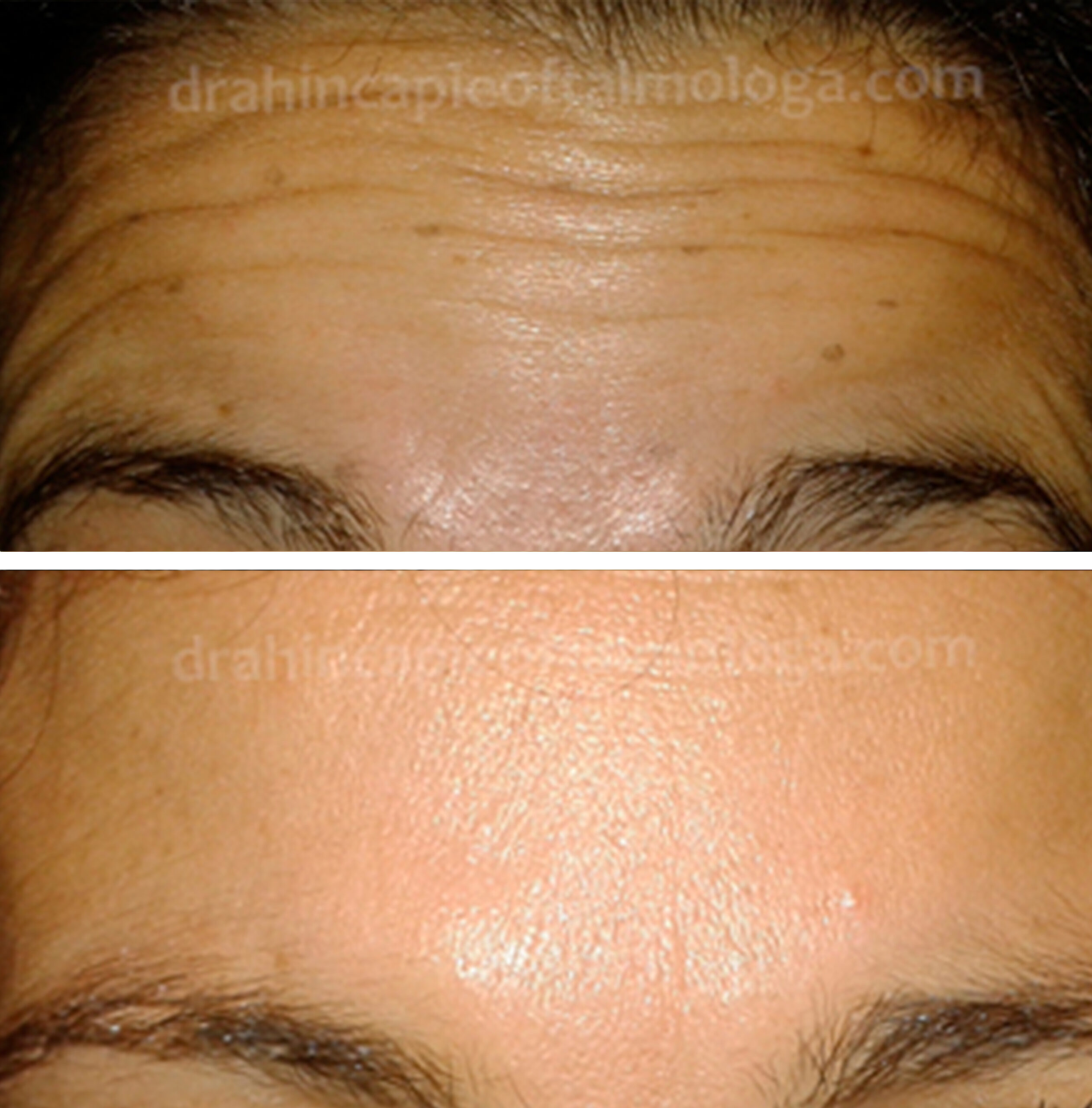 Tratamiento de arrugas de la frente con NEUROMODULADOR