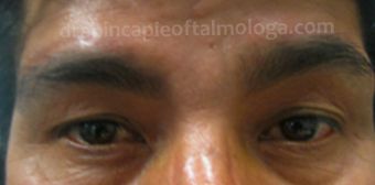 2 meses postoperatorio de cirugía de ptosis de cejas ambos ojos
