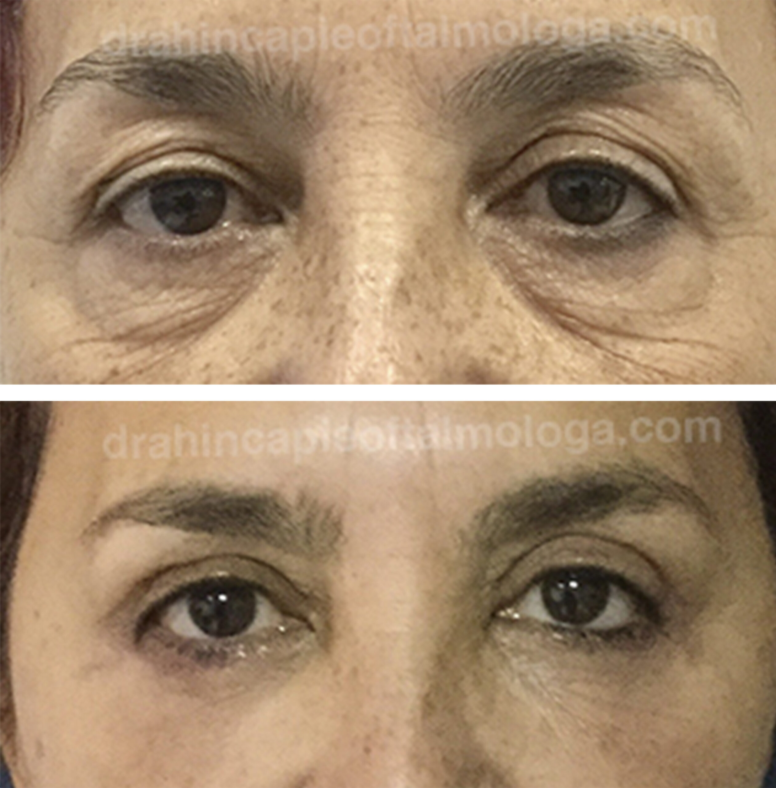 BLEFAROPLASTIA DE PÁRPADO SUPERIOR E INFERIOR