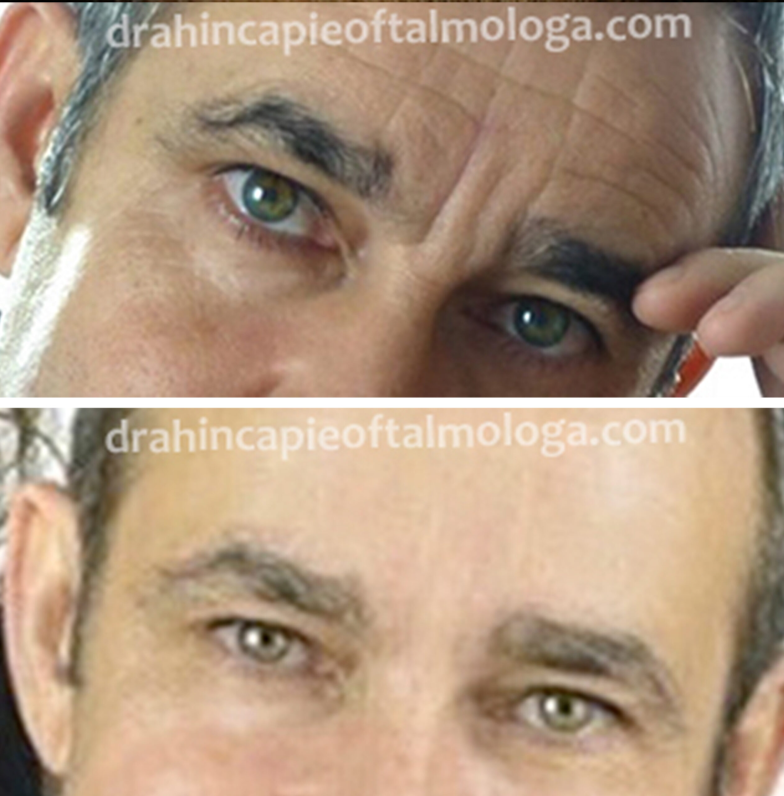 Tratamiento de arrugas de la frente con NEUROMODULADOR