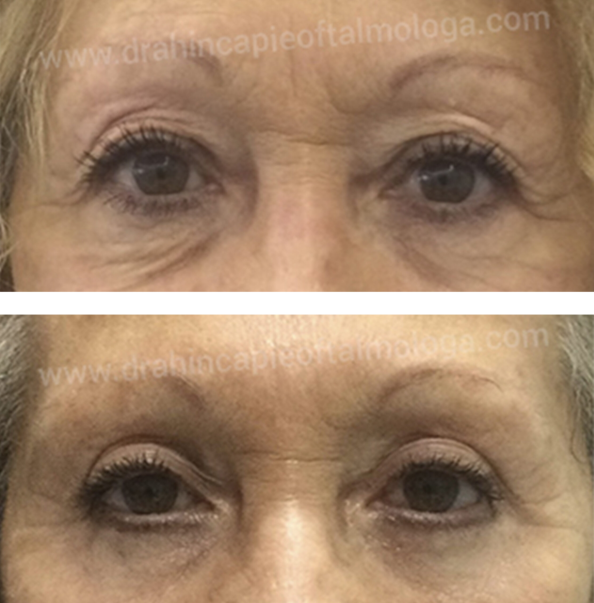 Blefaroplastia