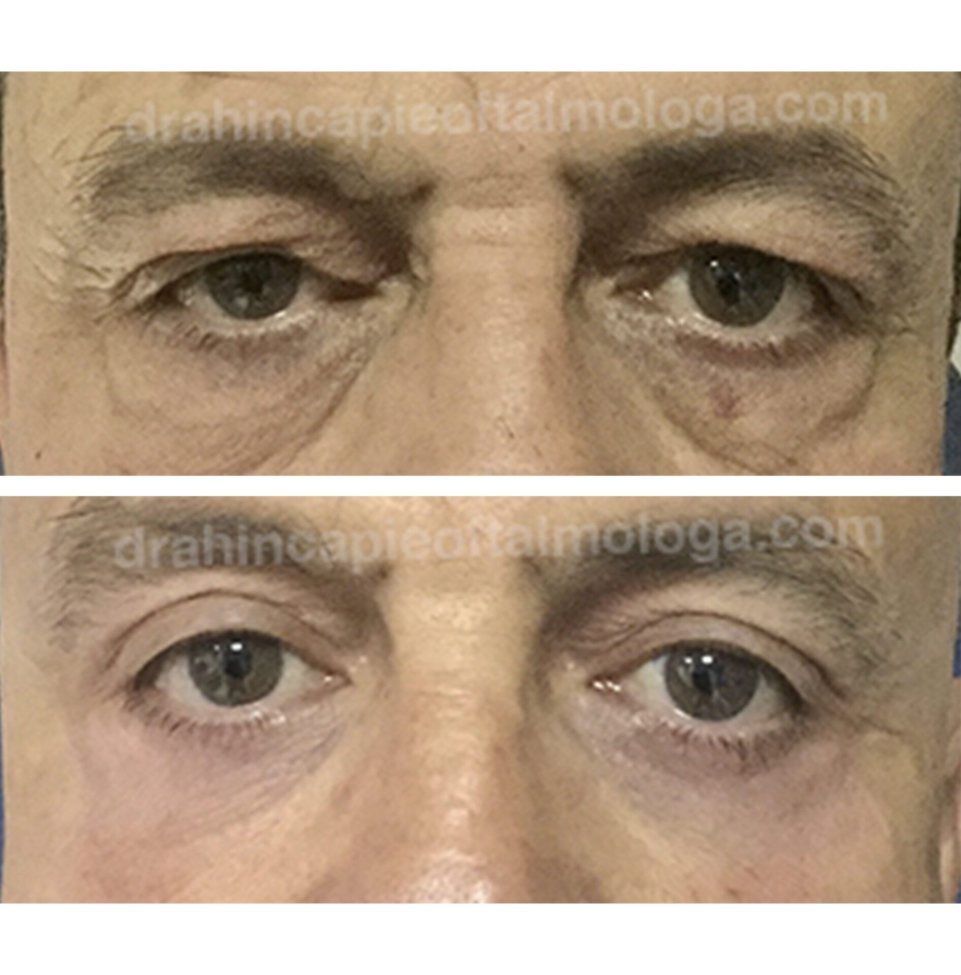 BLEFAROPLASTIA DE PÁRPADO SUPERIOR E INFERIOR