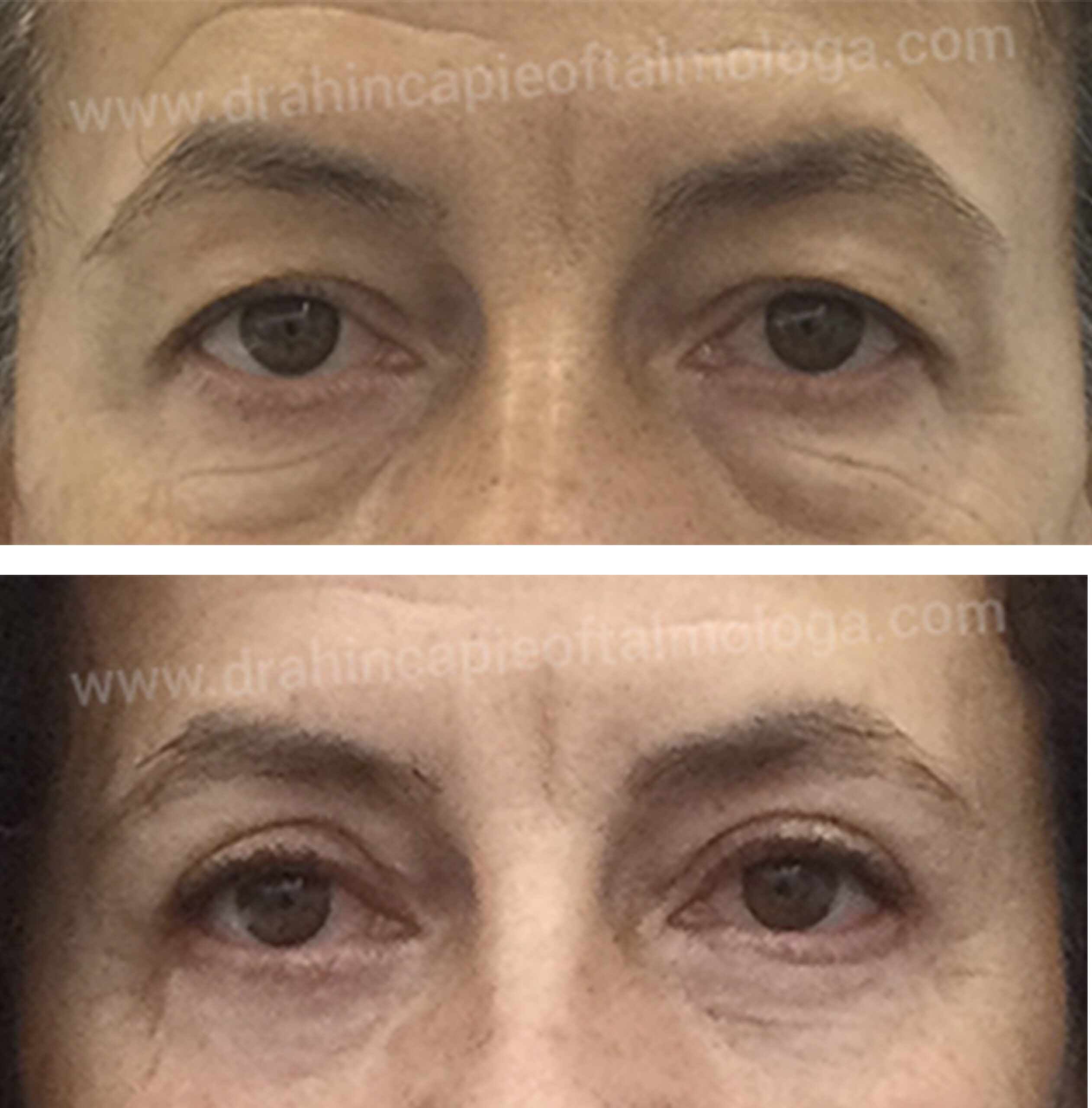 Blefaroplastia