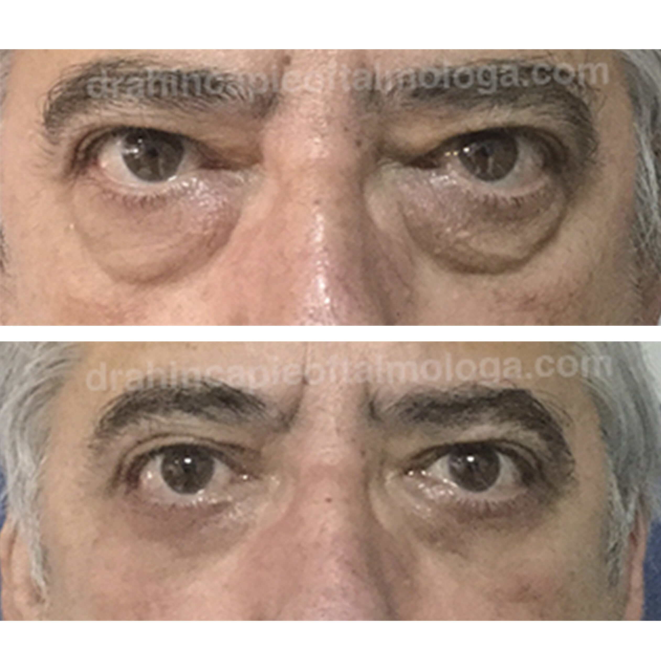 BLEFAROPLASTIA DE PÁRPADO SUPERIOR E INFERIOR