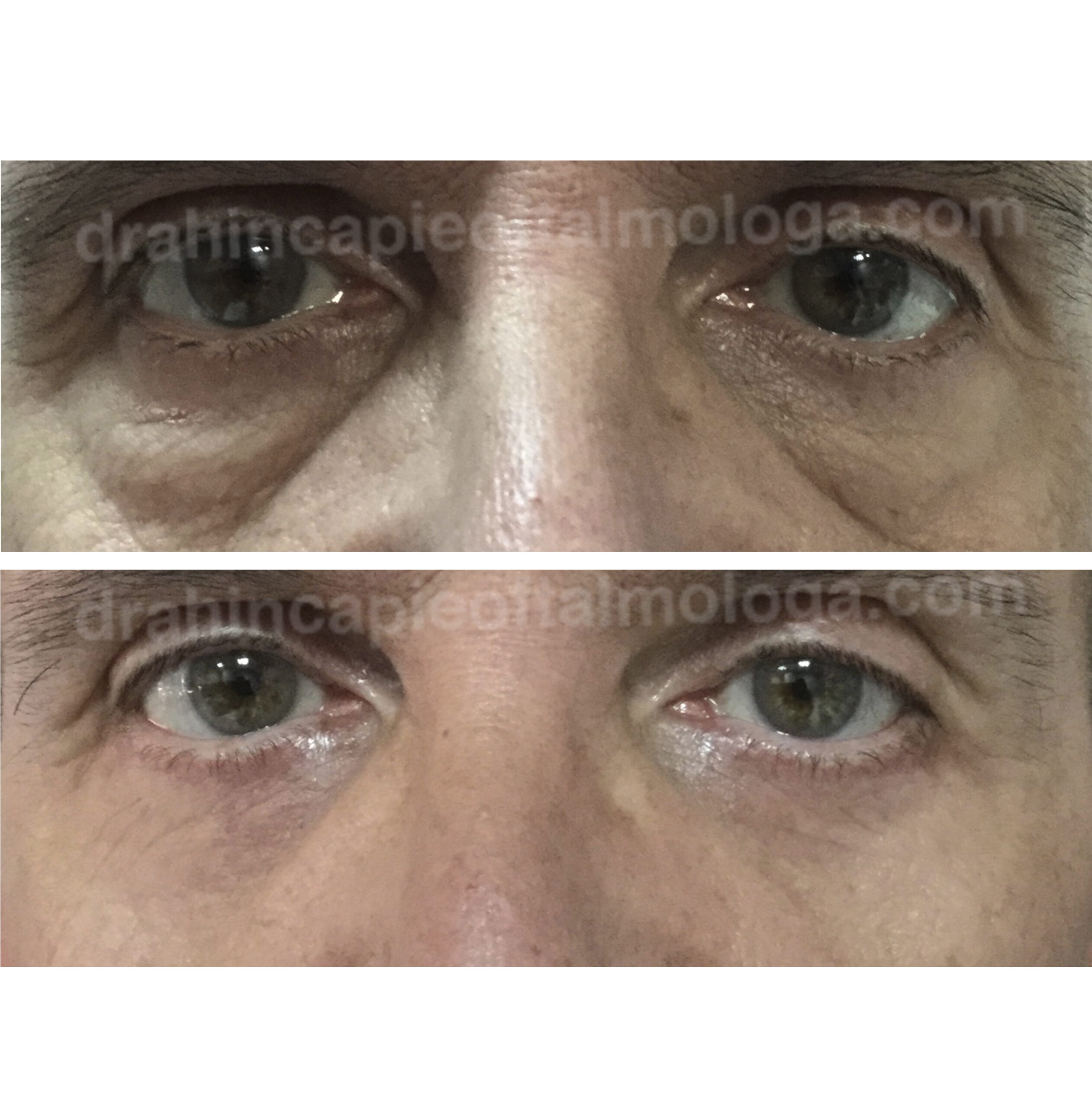 Blefaroplastia