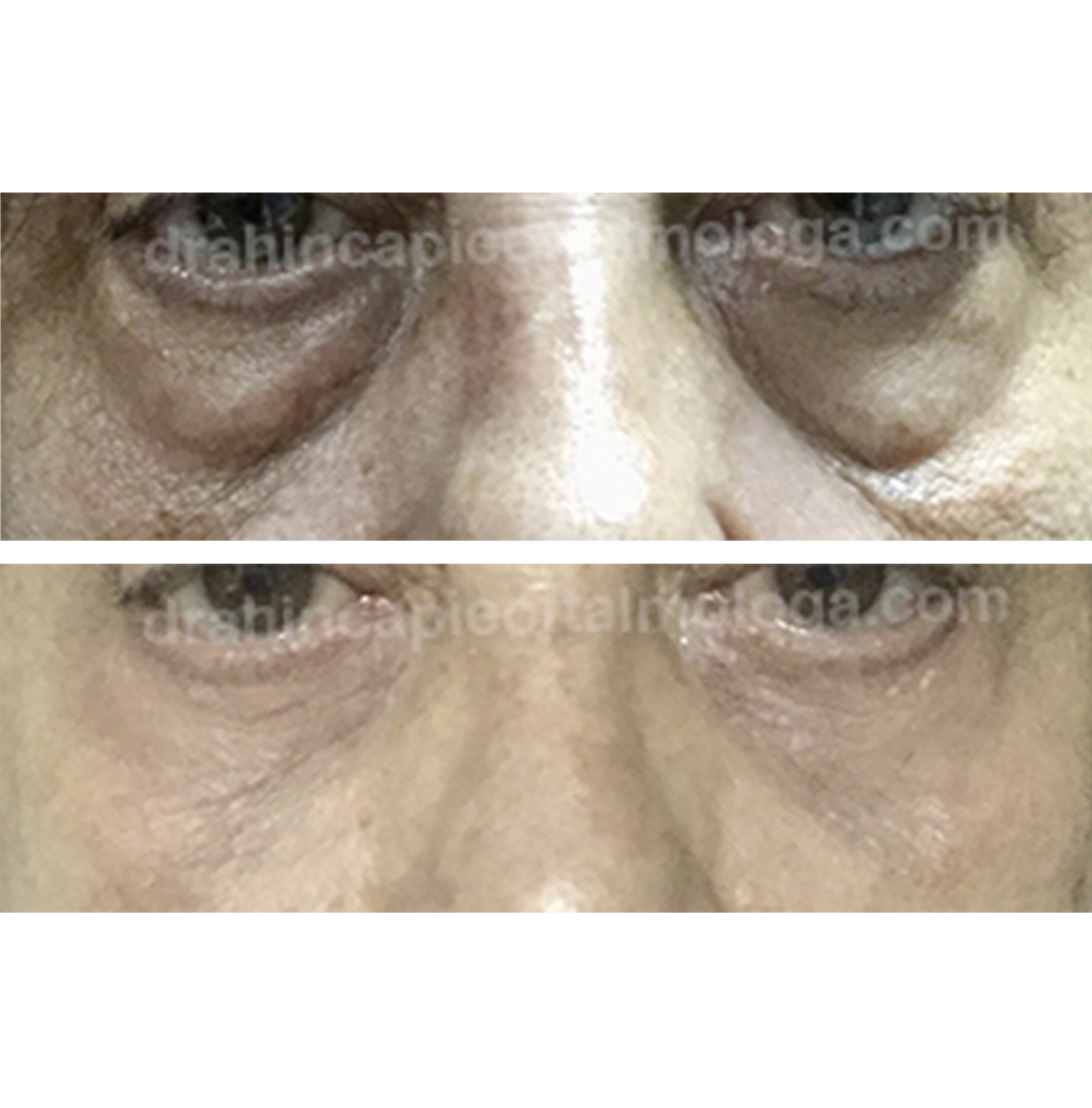 BLEFAROPLASTIA DE PÁRPADO INFERIOR