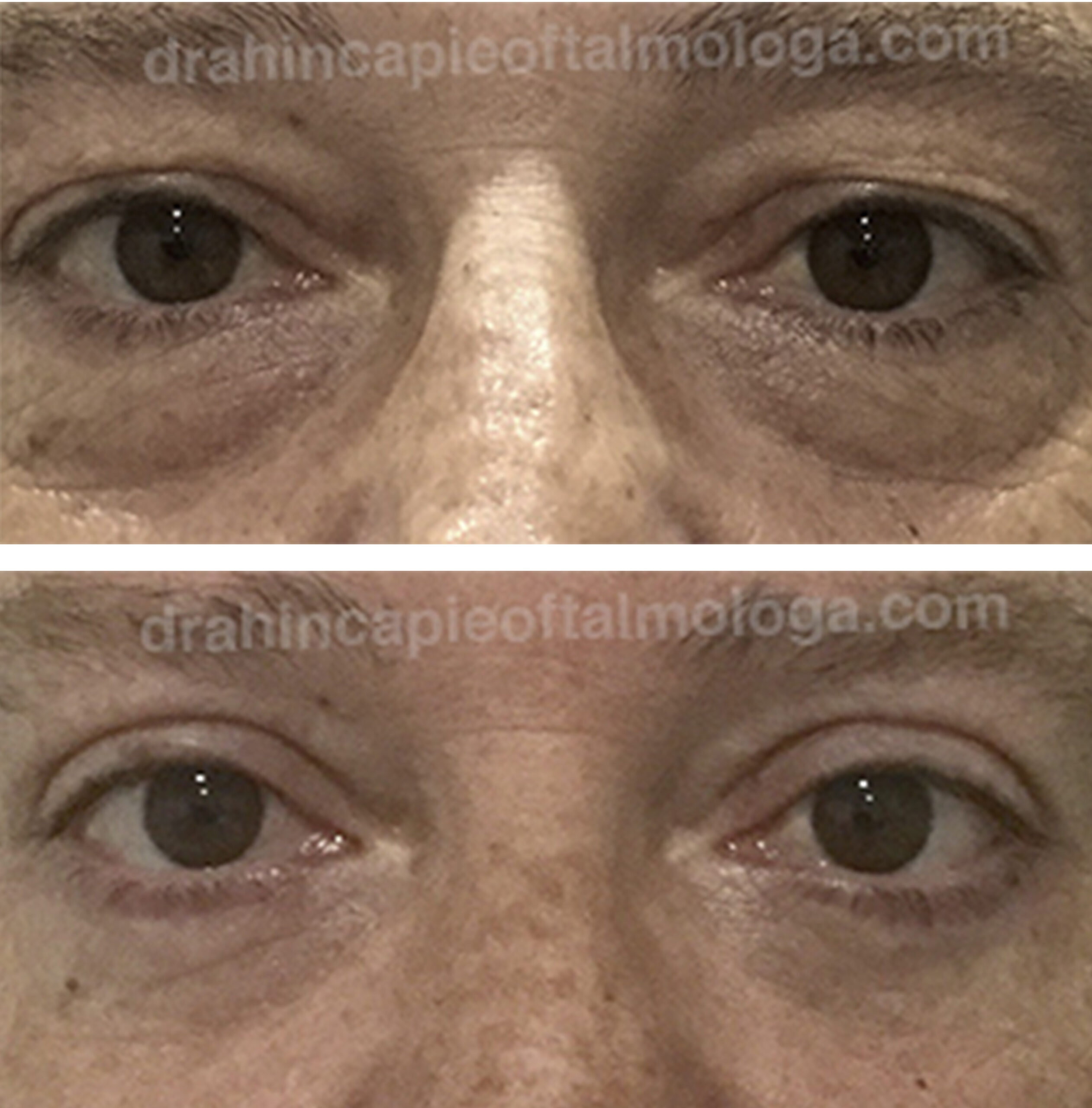 BLEFAROPLASTIA DE PÁRPADO SUPERIOR E INFERIOR