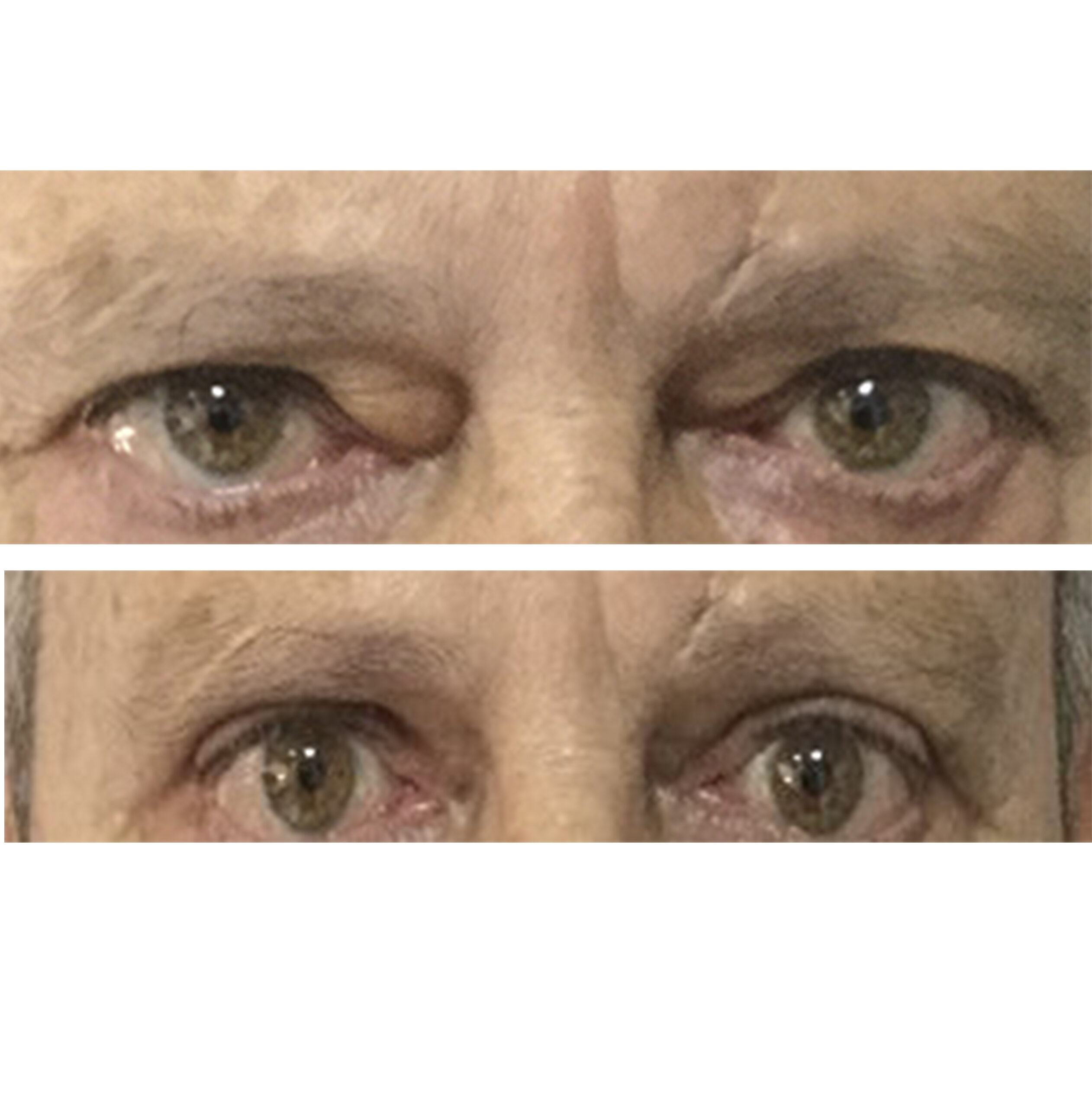 BLEFAROPLASTIA DE PARPADO SUPERIOR