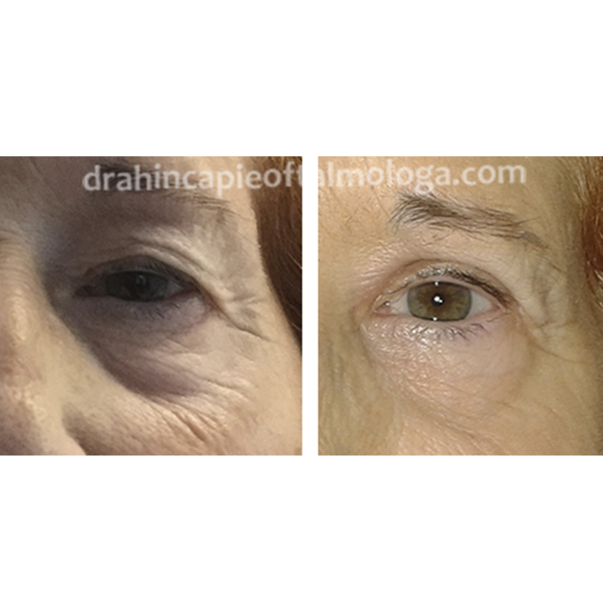 Blefaroplastia antes y después