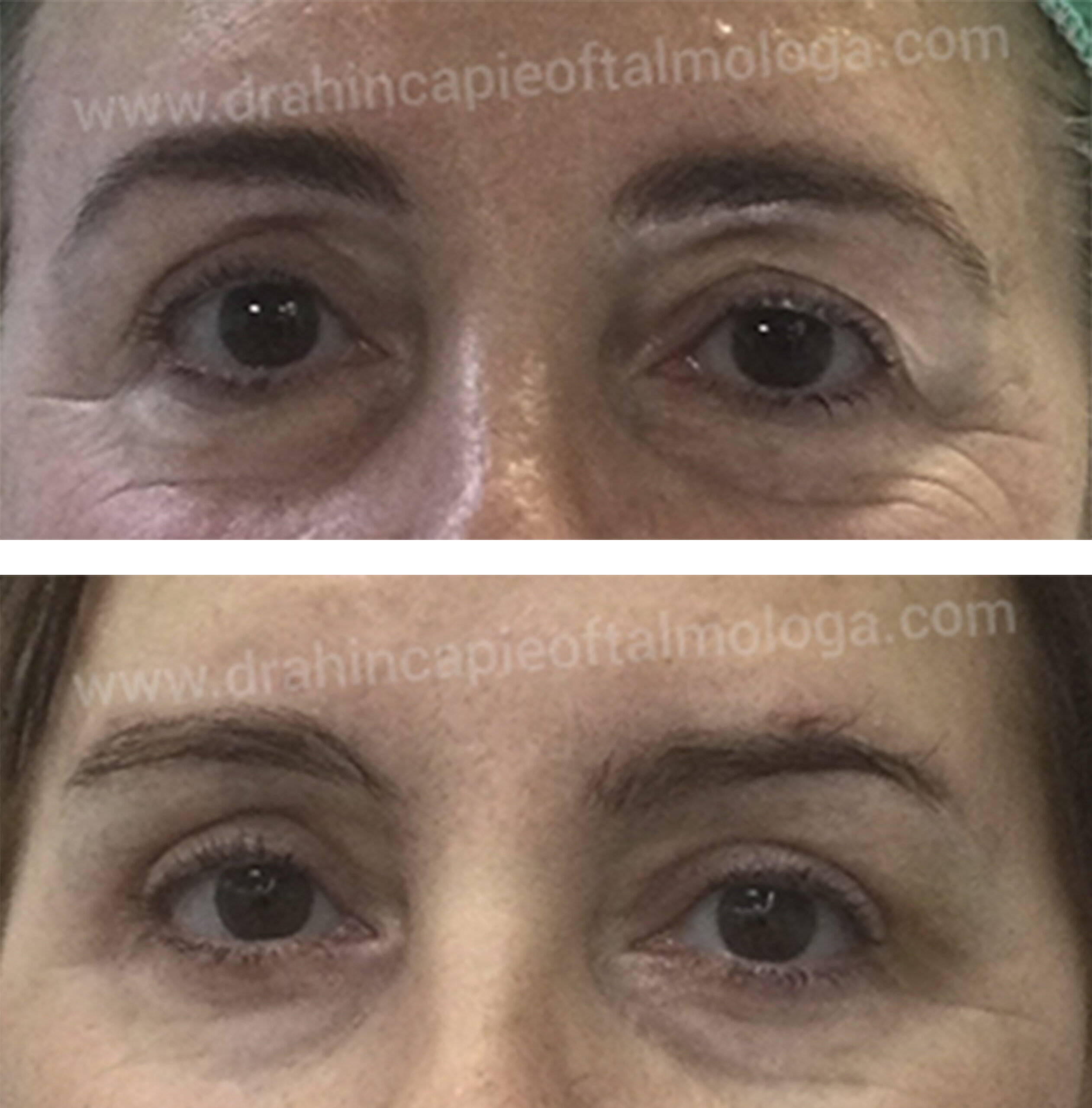 Blefaroplastia y cejaplastia directa 6 meses después