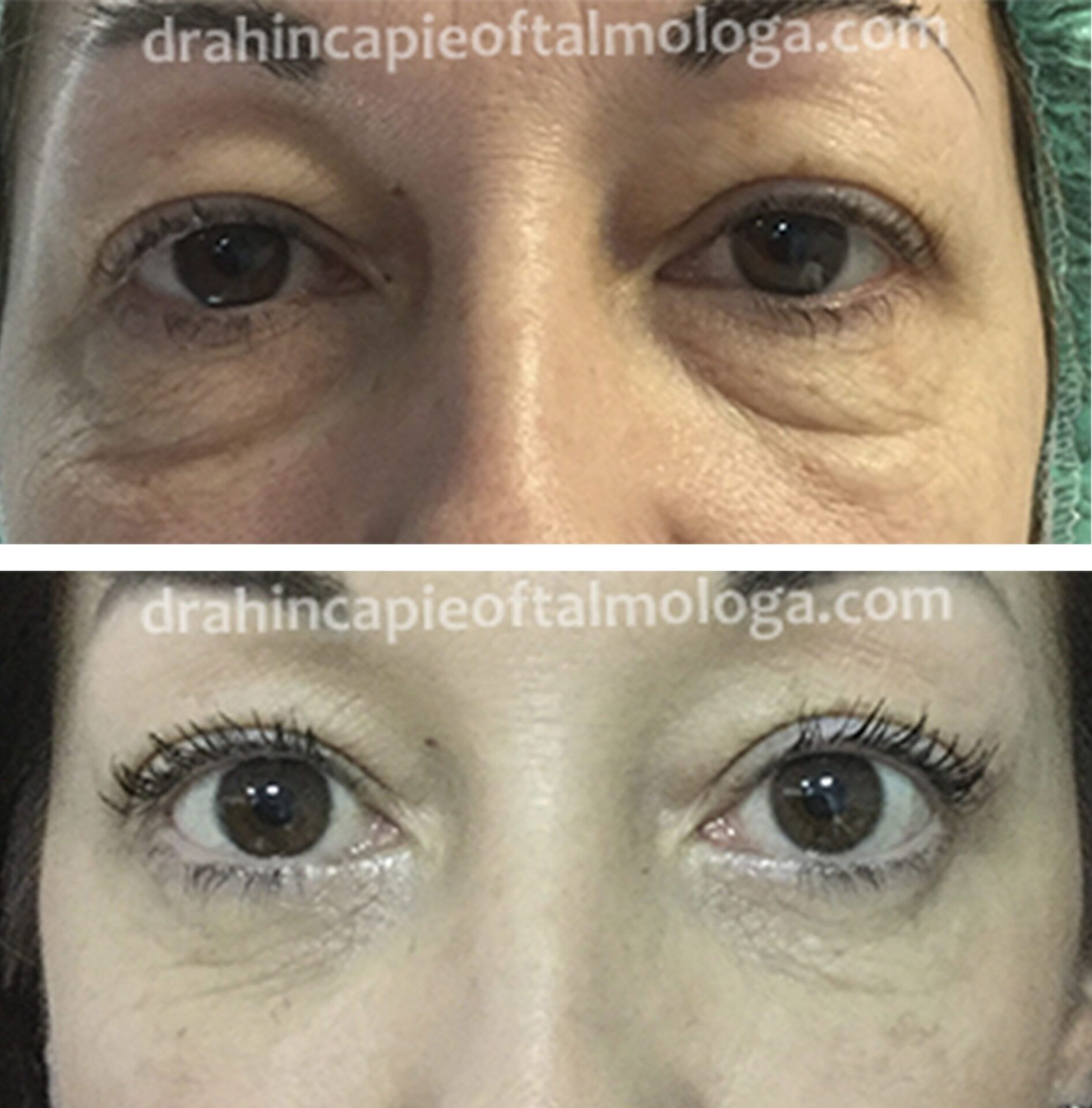 Cirugía de BLEFAROPLASTIA de párpados inferiores