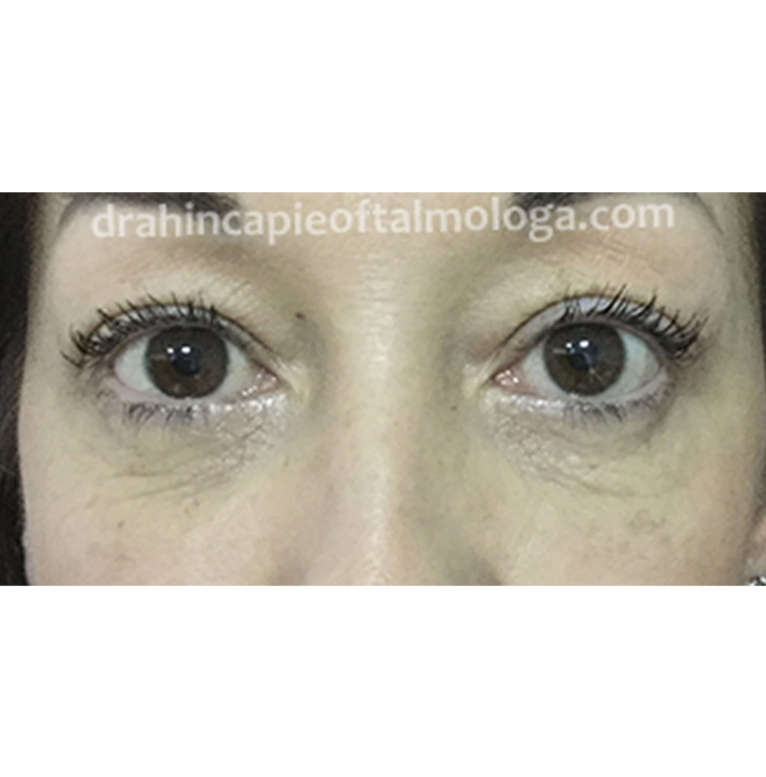 DESPUÉS de cirugía de BLEFAROPLASTIA de párpados inferiores