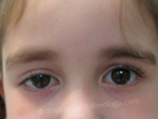 Preoperatorio Ptosis palpebral congénita OD
