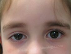 Preoperatorio Ptosis palpebral congénita OD