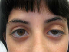 Preoperatorio Ptosis palpebral congénita OI
