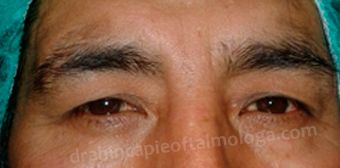 Ptosis de ceja bilateral