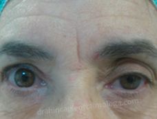 Ptosis palpebral aponeurótica OI