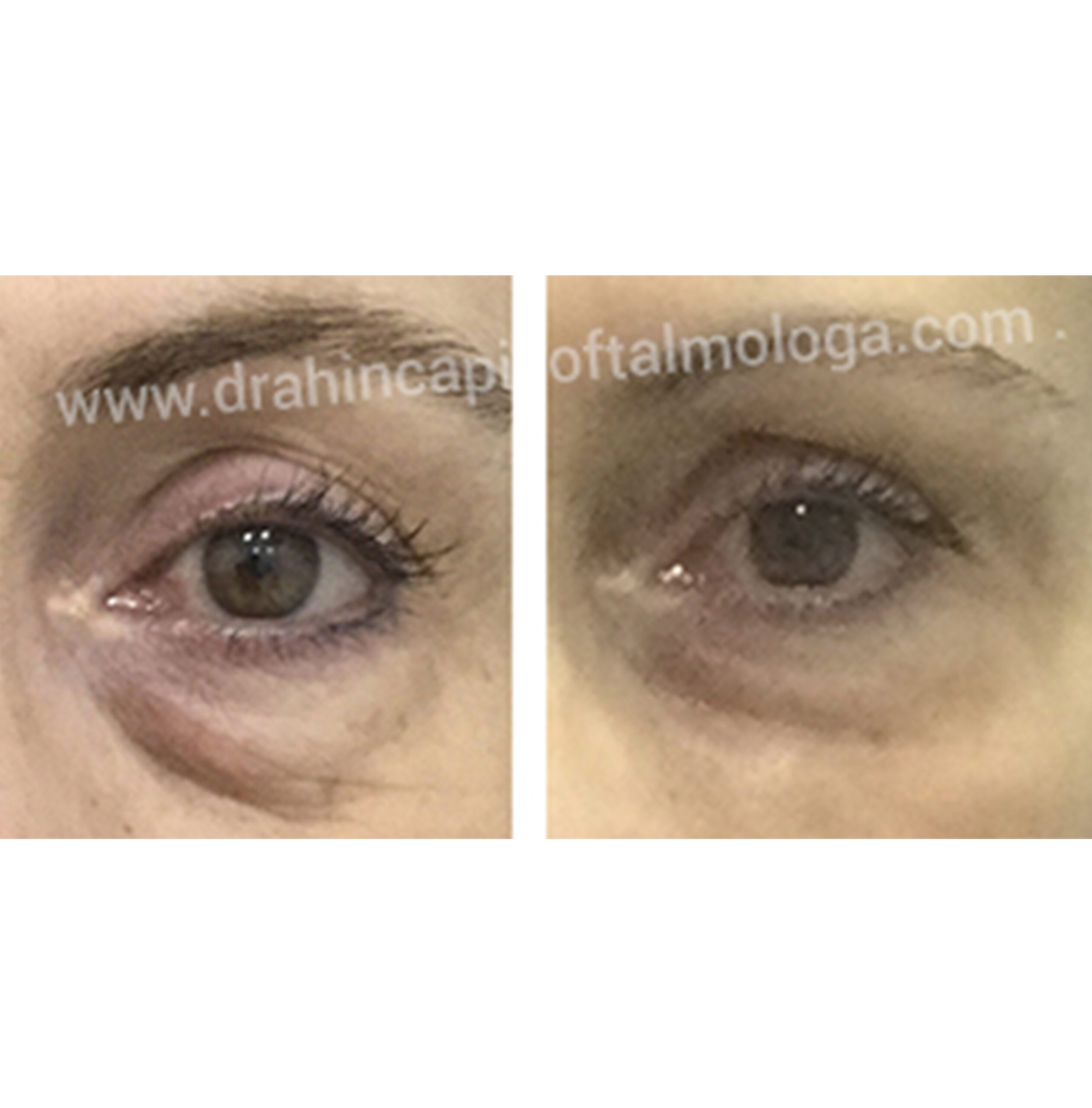 Rejuvenecimiento periocular SIN cirugía . Tratamiento con ácido hialuronico