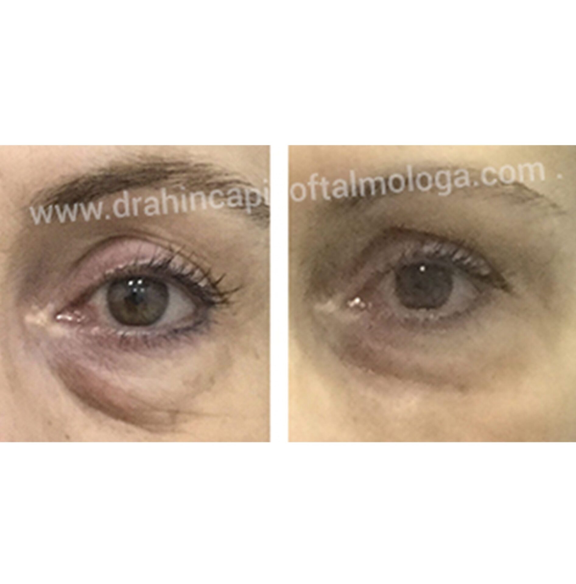 Rejuvenecimiento periocular SIN cirugía . Tratamiento con ácido hialuronico
