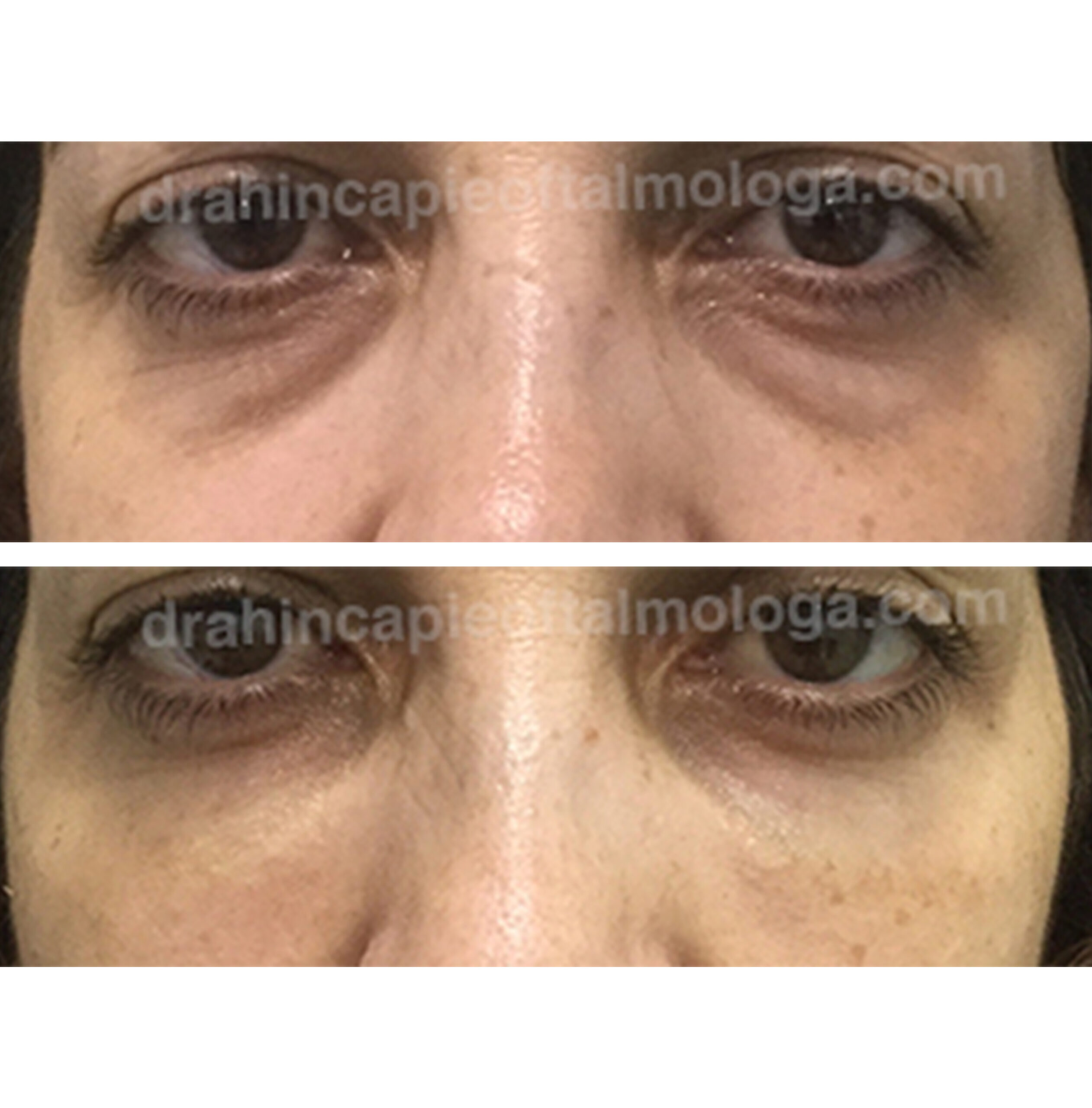 Tratamiento de las bolsas de grasa y ojeras con acido hialurónico