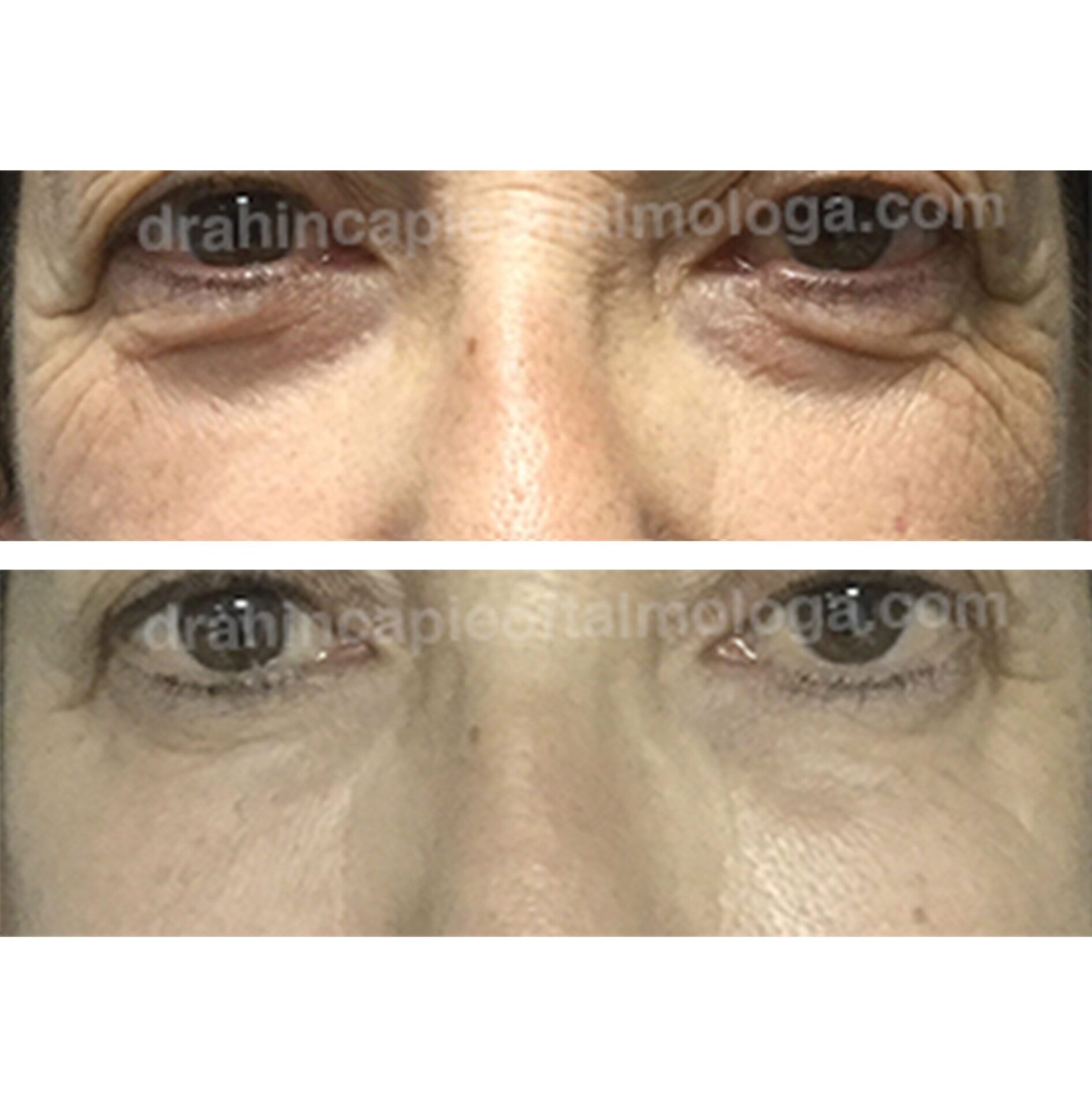 Tratamiento de las bolsas de grasa y ojeras con acido hialurónico