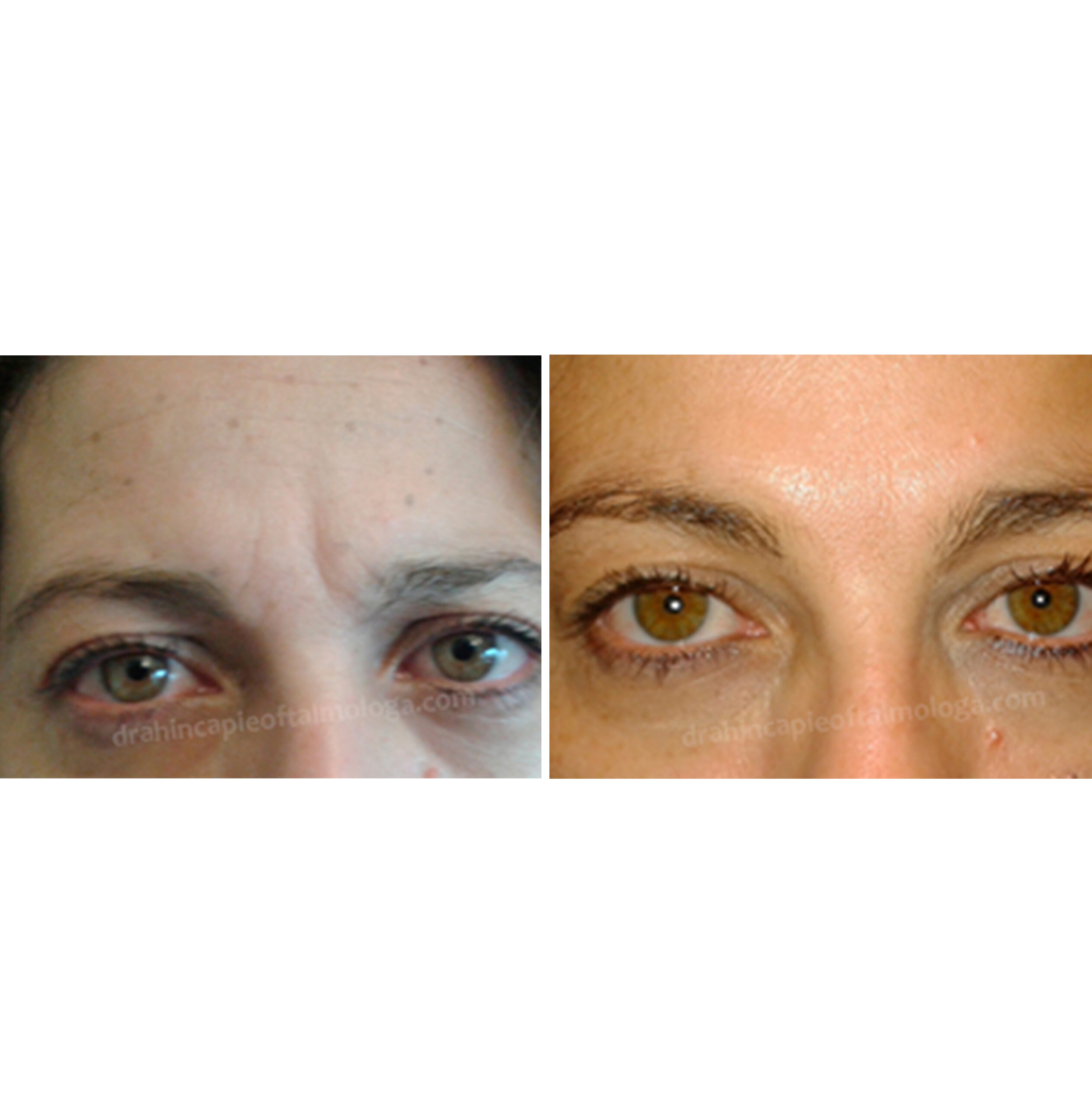 Tratamiento de líneas del entrecejo con NEUROMODULADOR