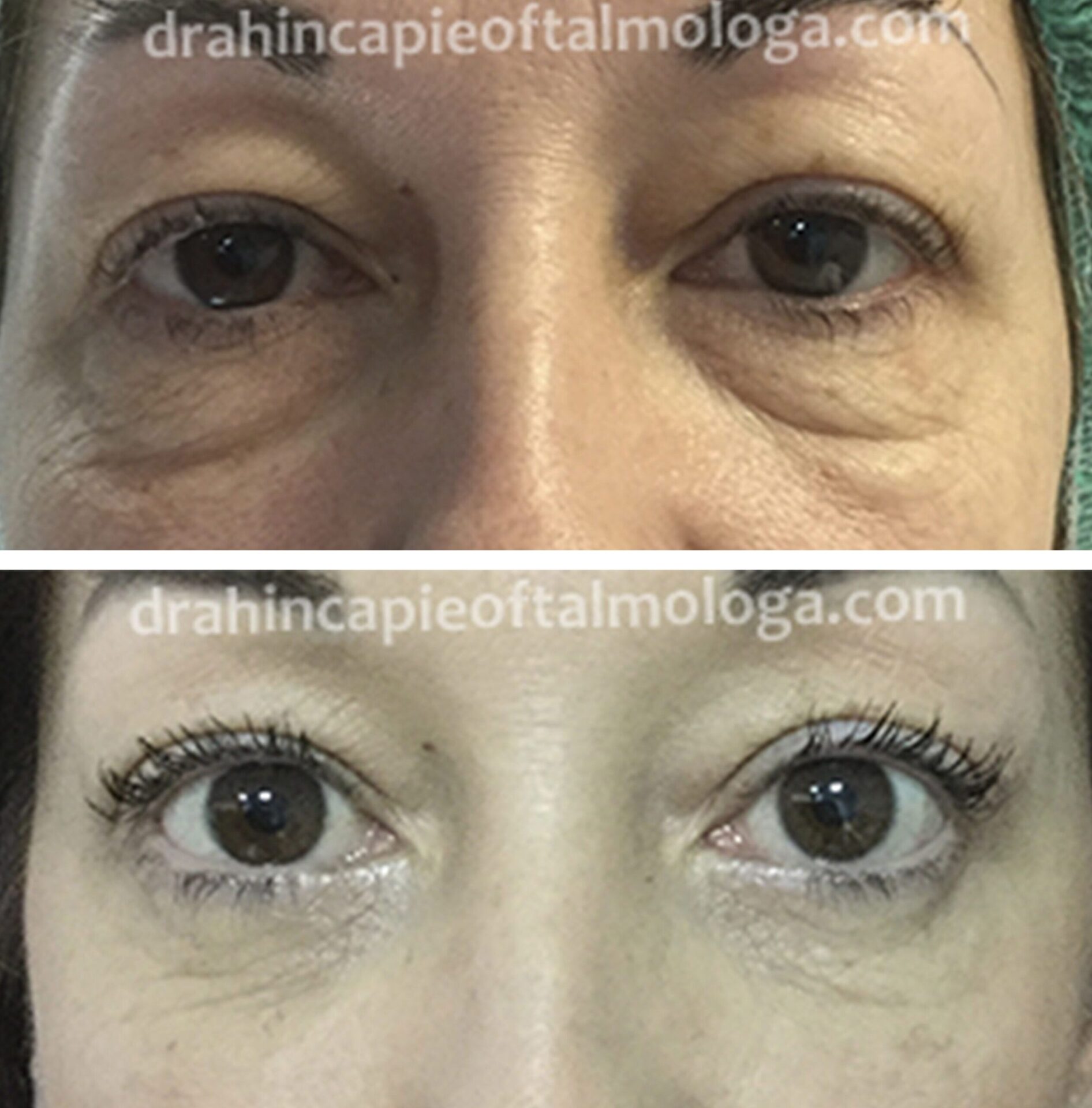 Cirugía de BLEFAROPLASTIA de párpados inferiores