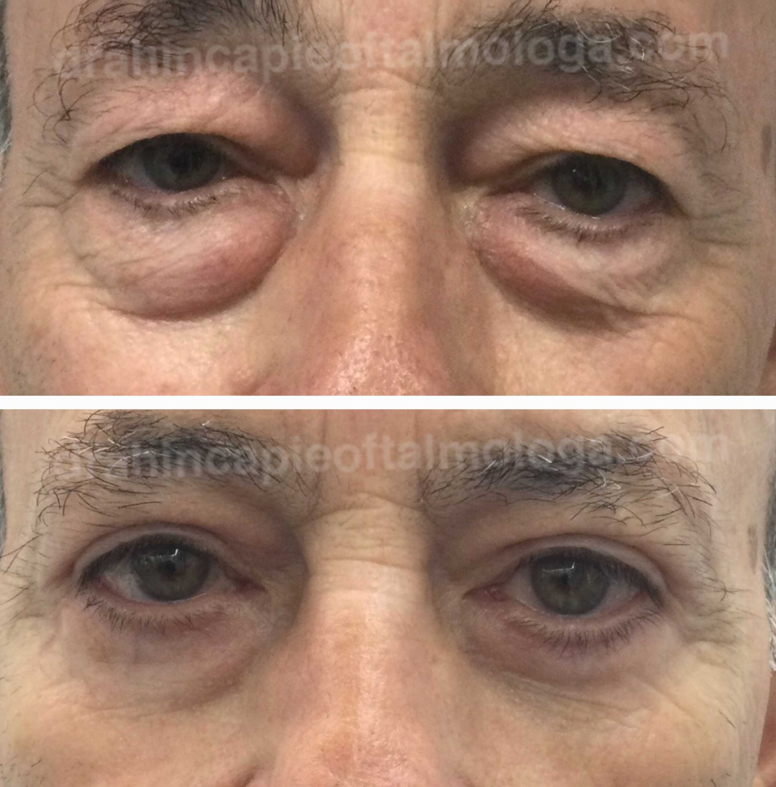 Blefaroplastia