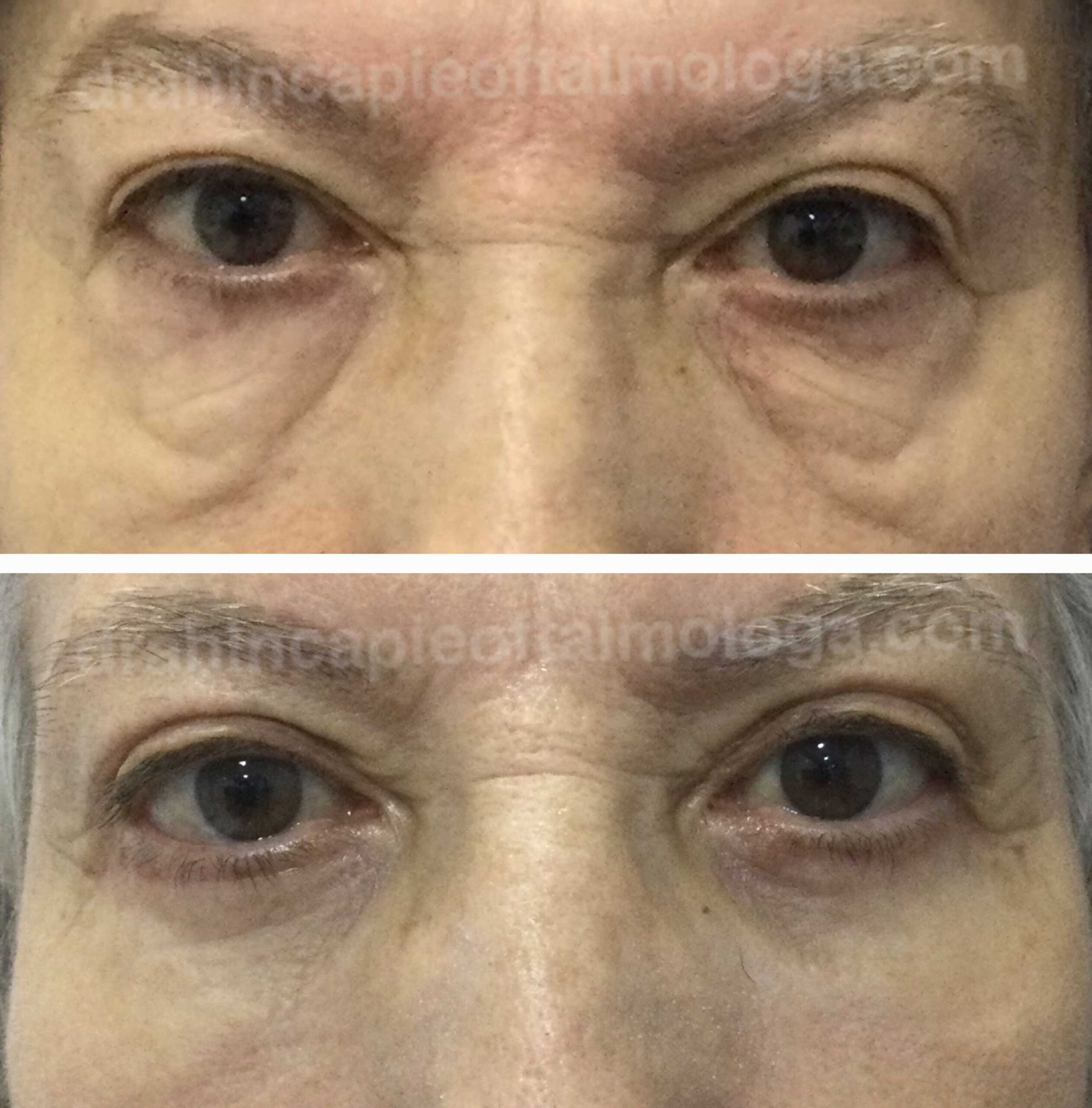Blefaroplastia