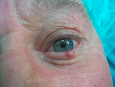 Carcinoma basocelular
