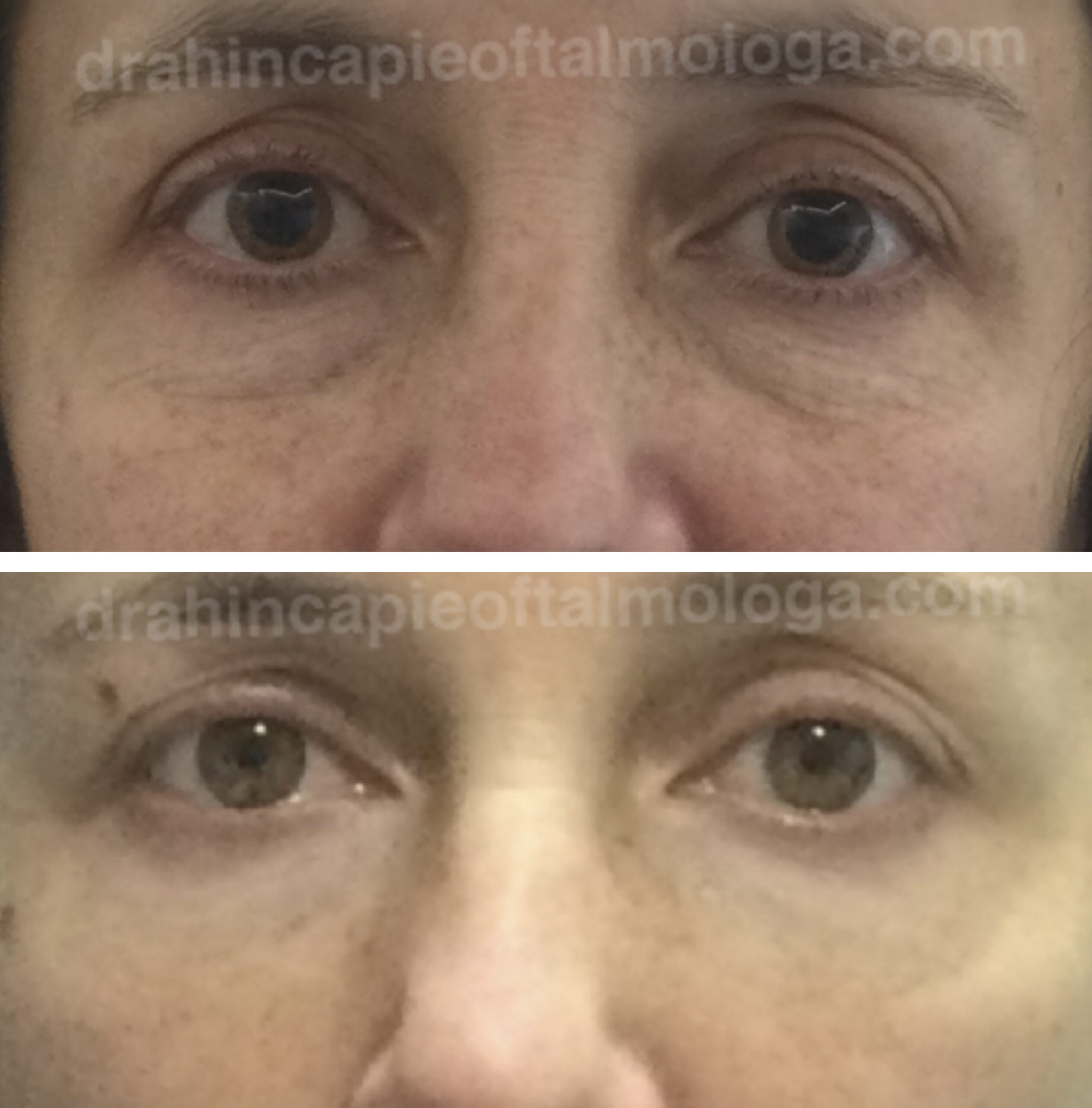 Tratamiento de bolsas de grasa y ojeras