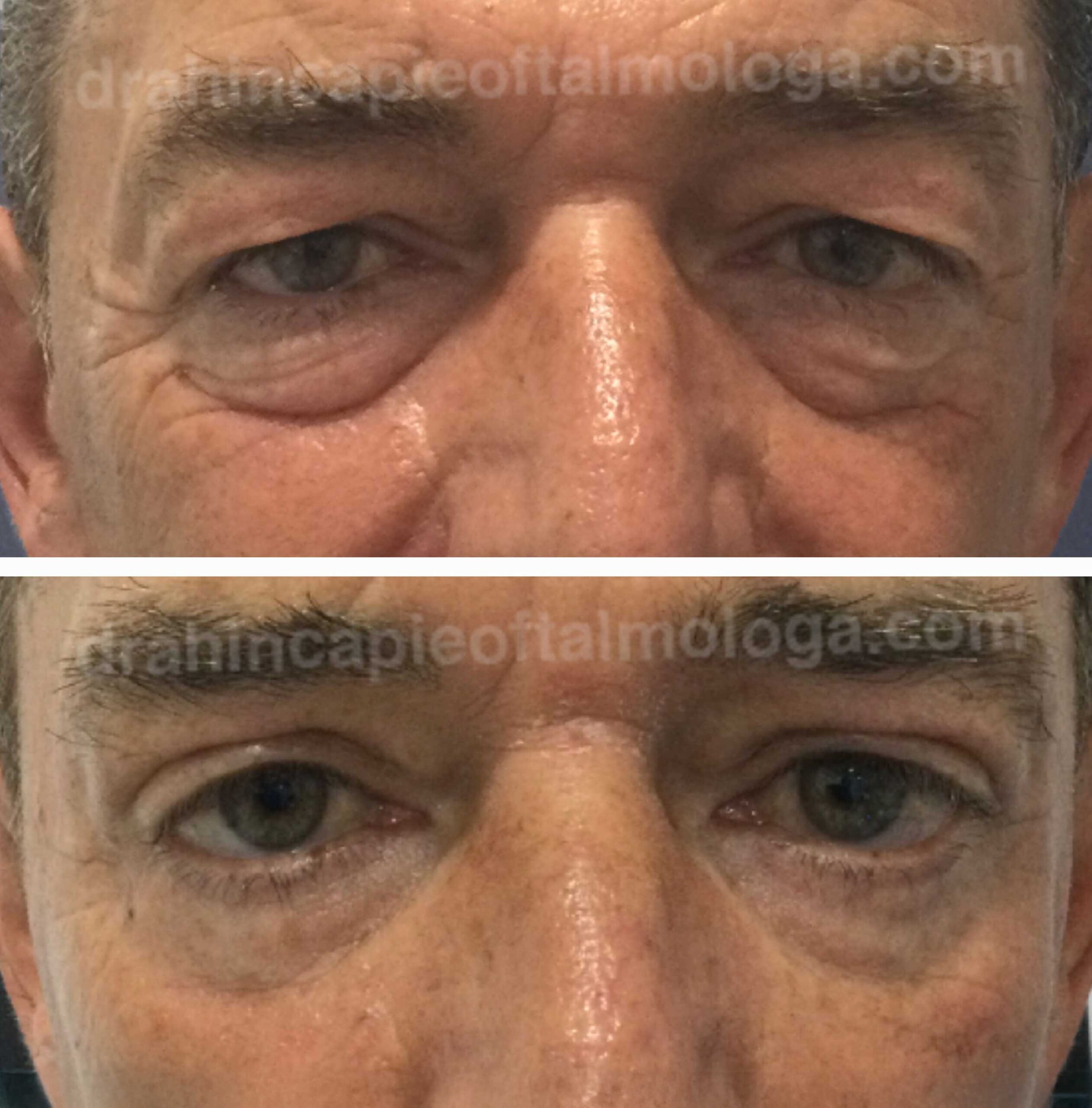 Blefaroplastia