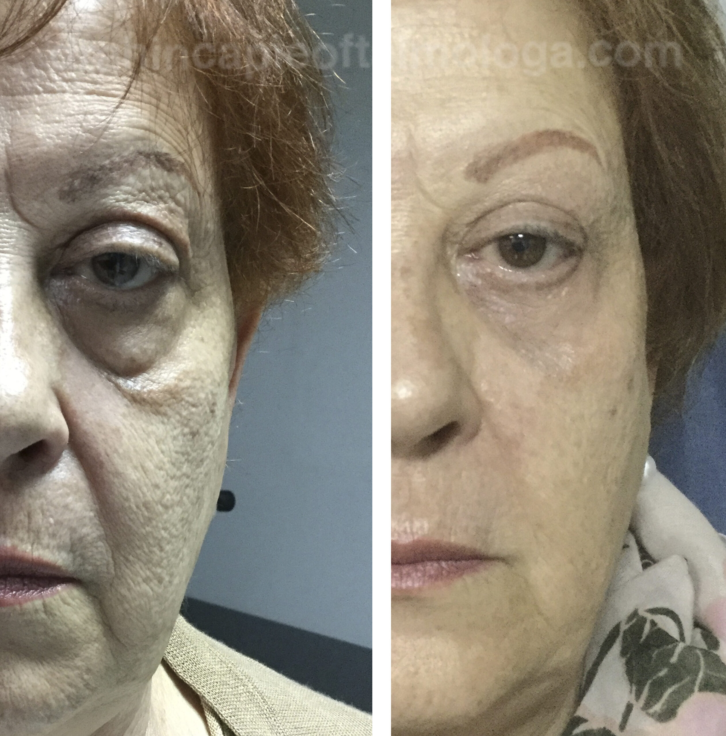 Blefaroplastia completa y rejuvenecimiento facial