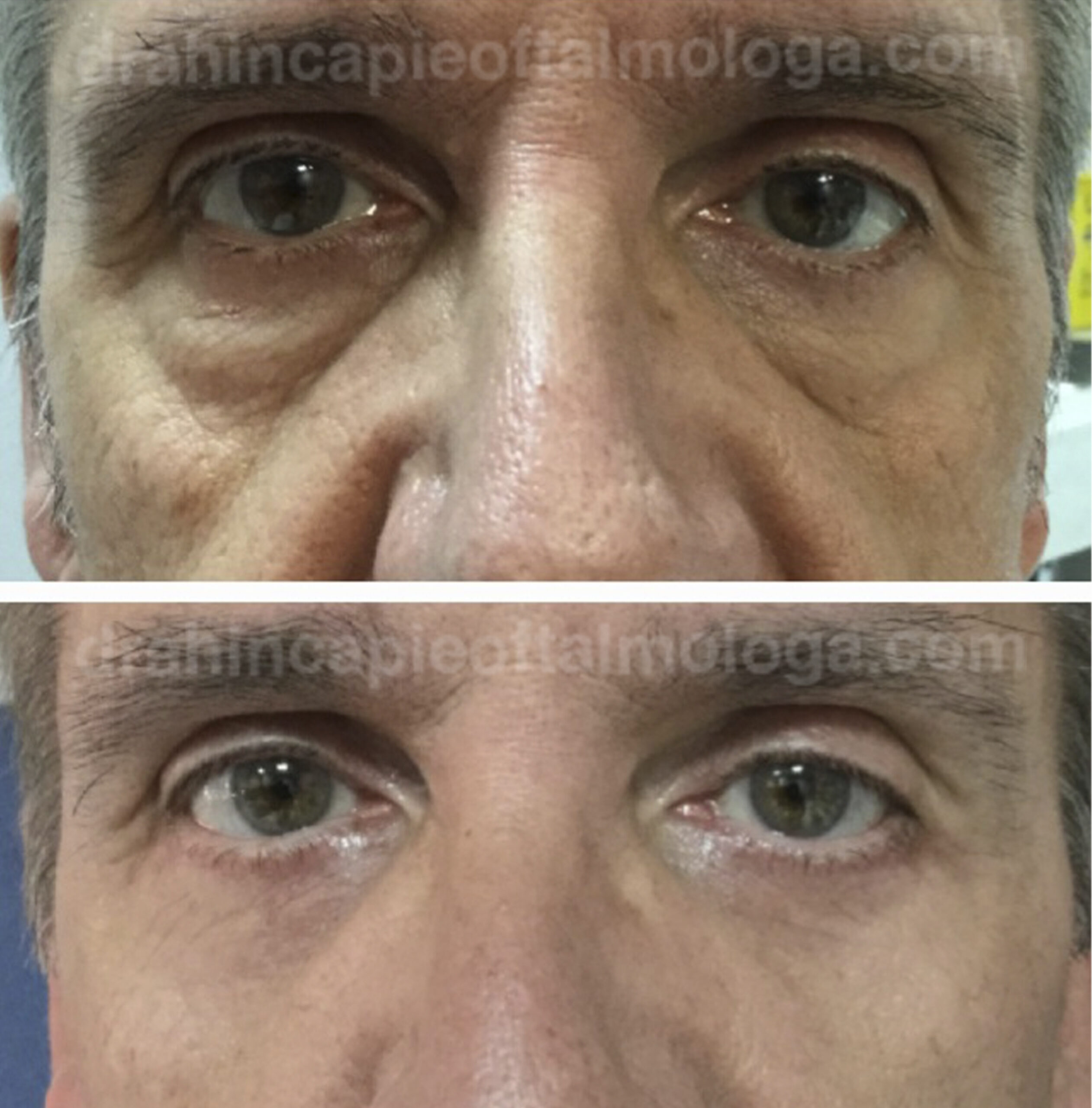 Blefaroplastia de parpado inferior / bolsas y ojeras