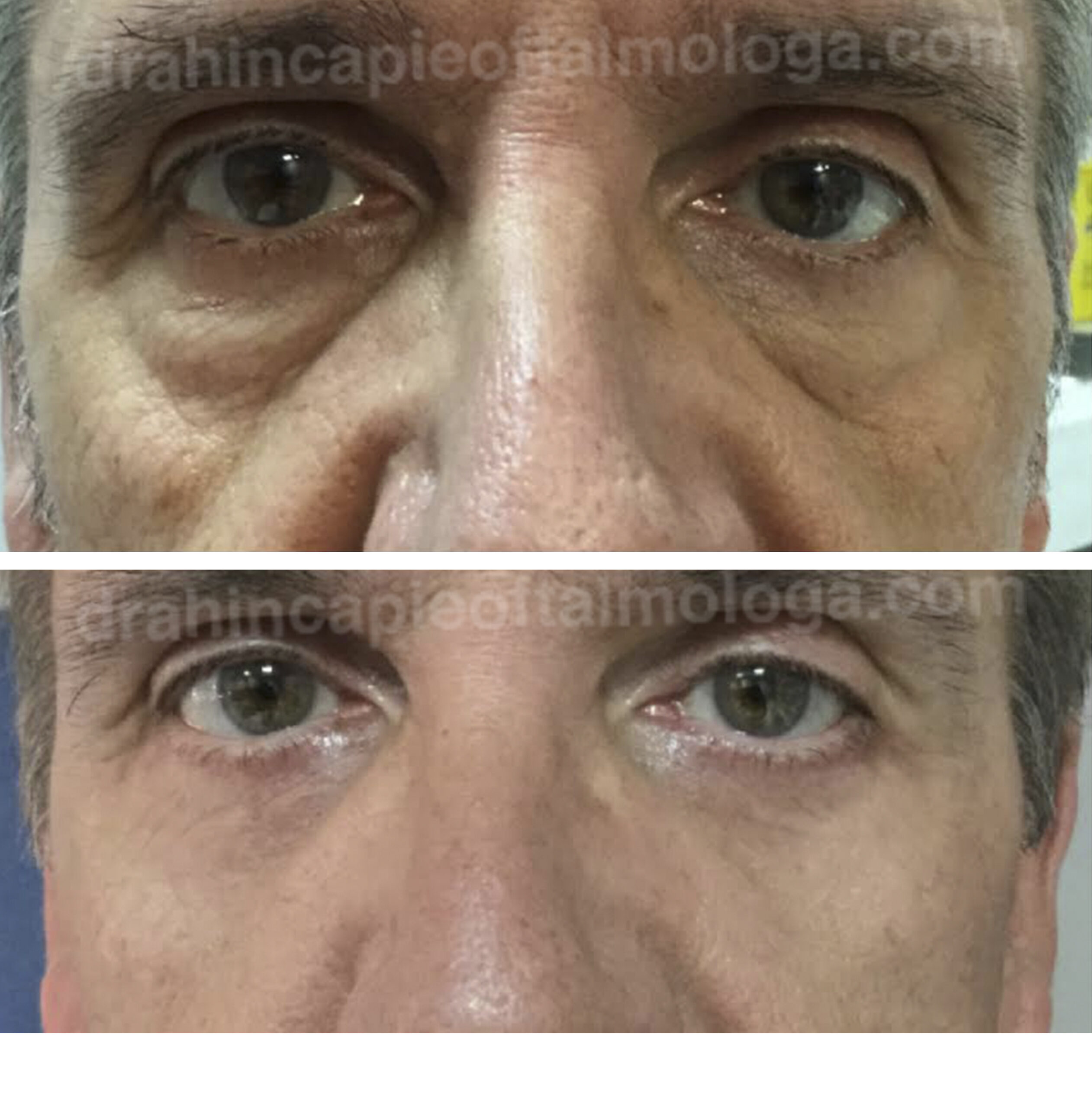 Blefaroplastia de párpados inferiores / cirugiabde bolsas