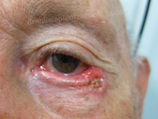 Carcinoma basocelular