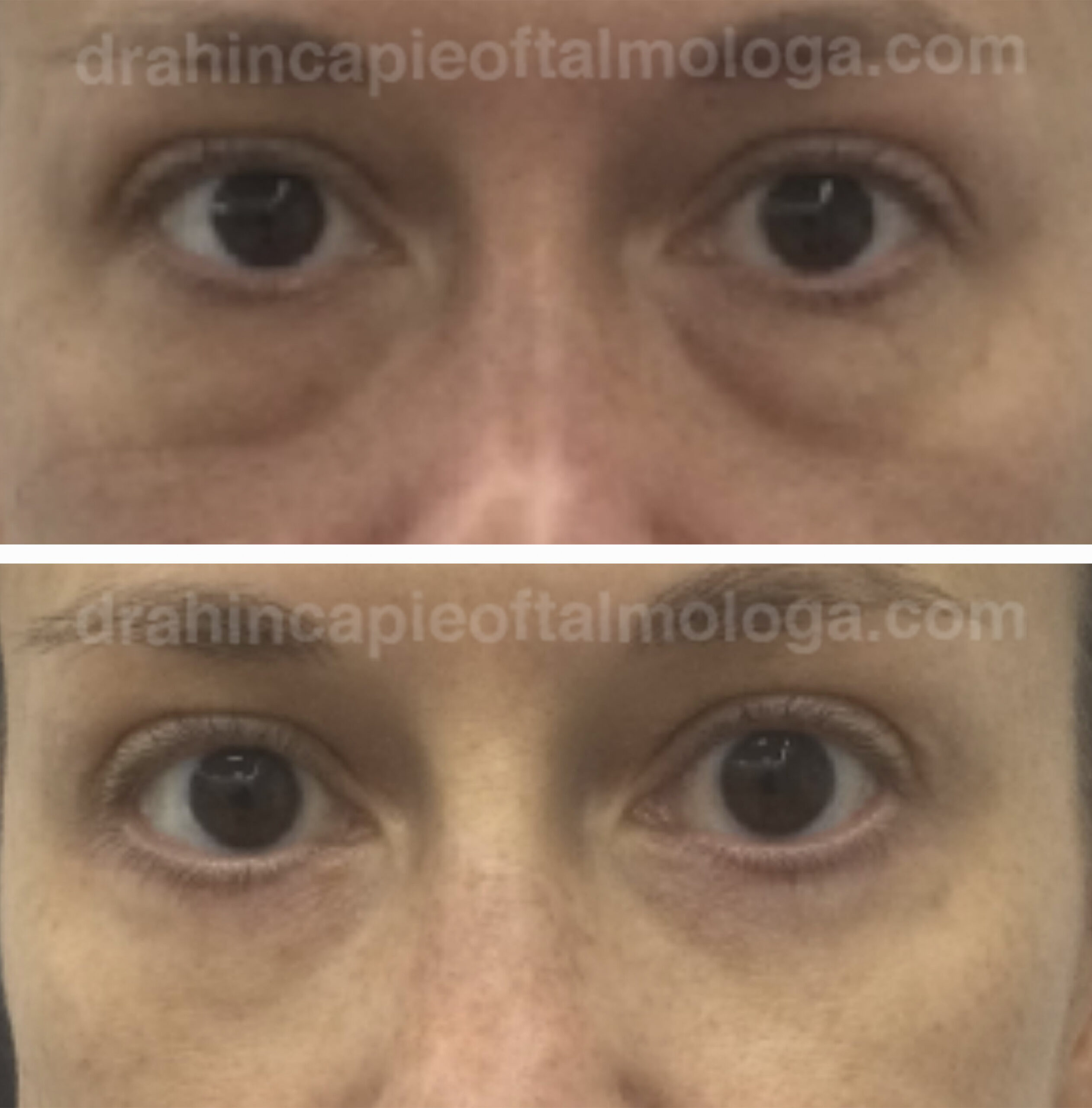 Cirugia de bolsas y ojeras con láser