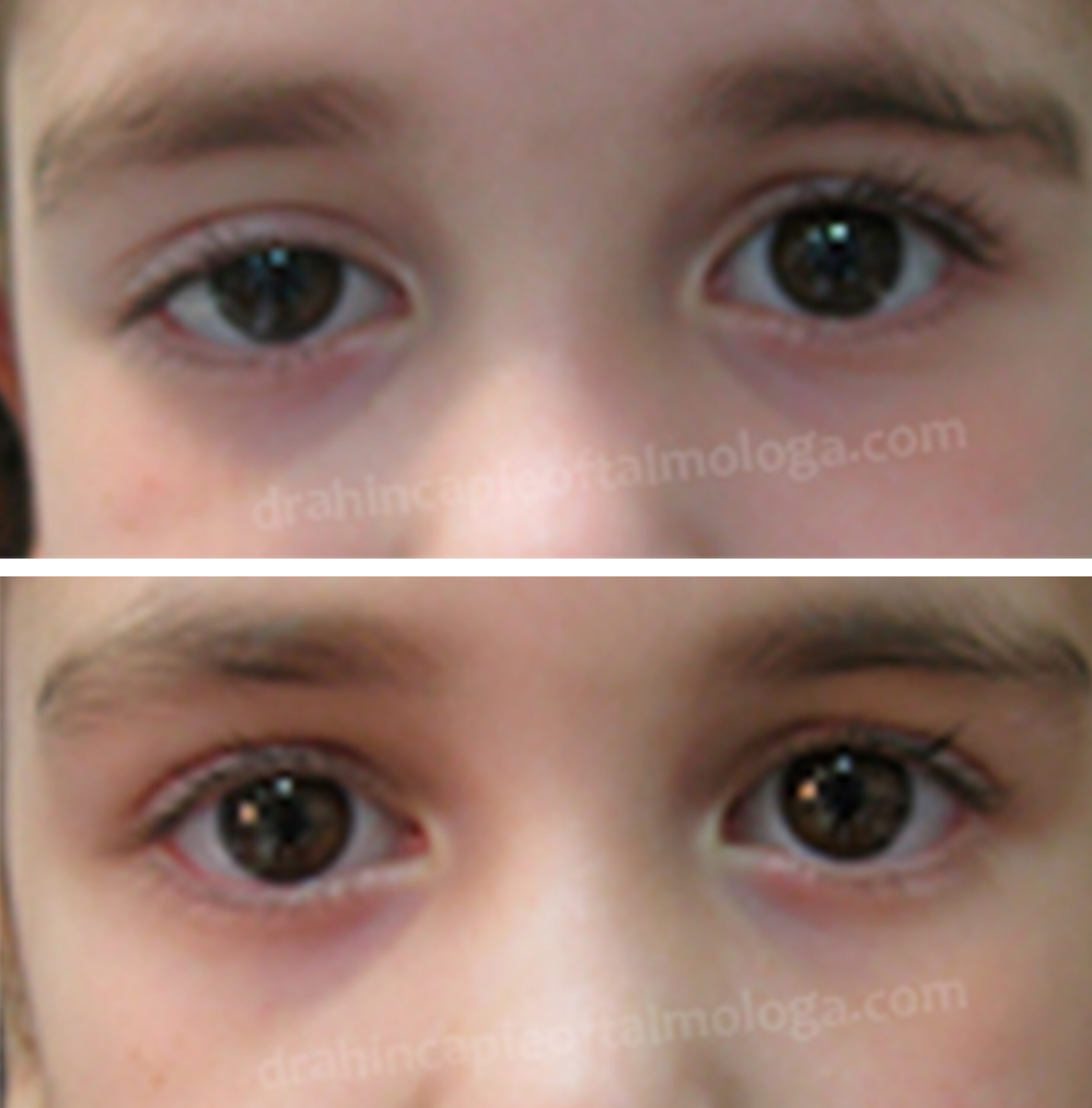 Corrección Ptosis palpebral congénita ODCorrección Ptosis palpebral congénita OD