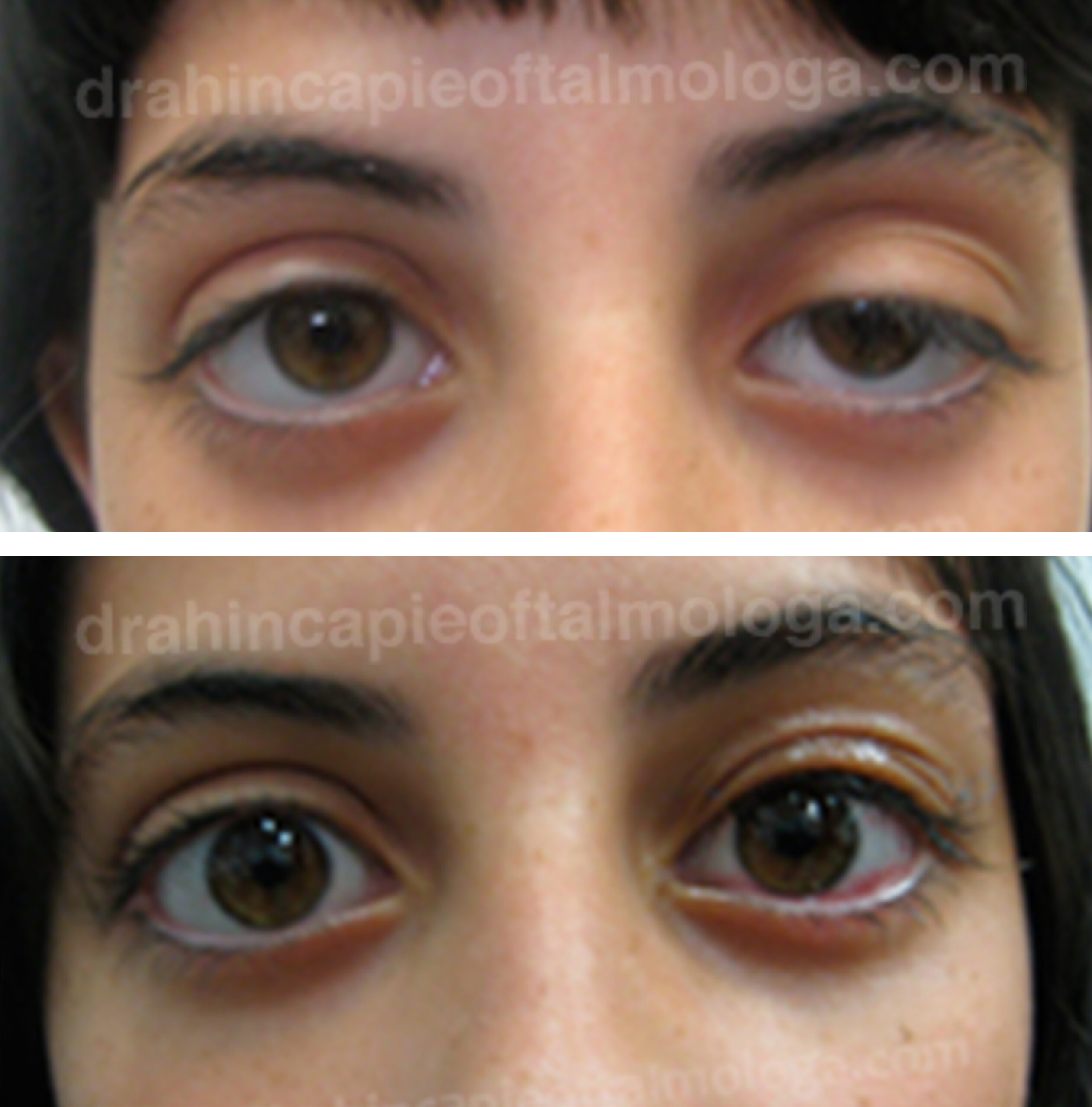 15 dias Postoperatorio Corrección ptosis palpebral OI