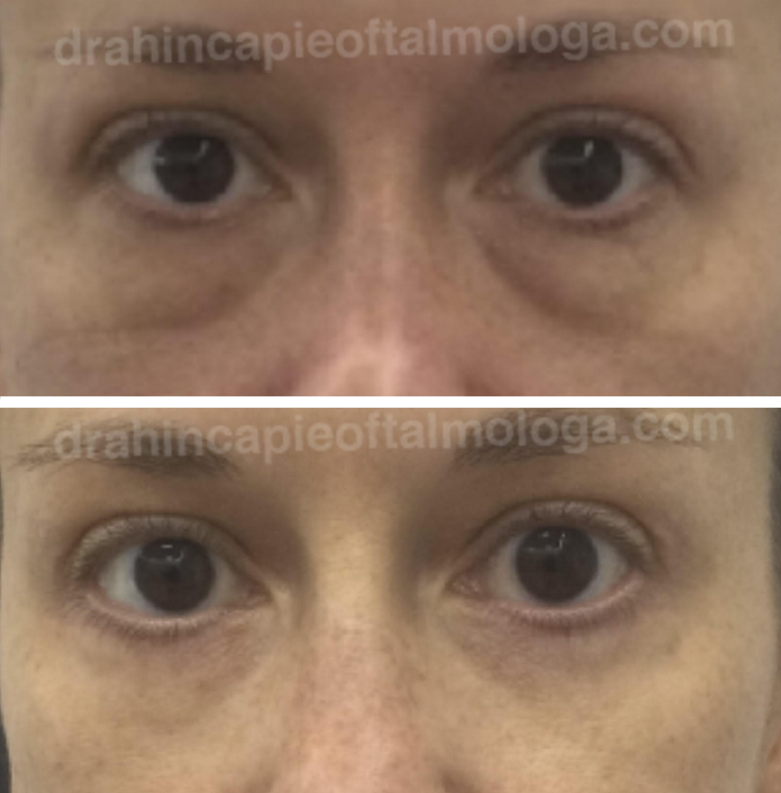 Tratamiento de bolsas de grasa y ojeras