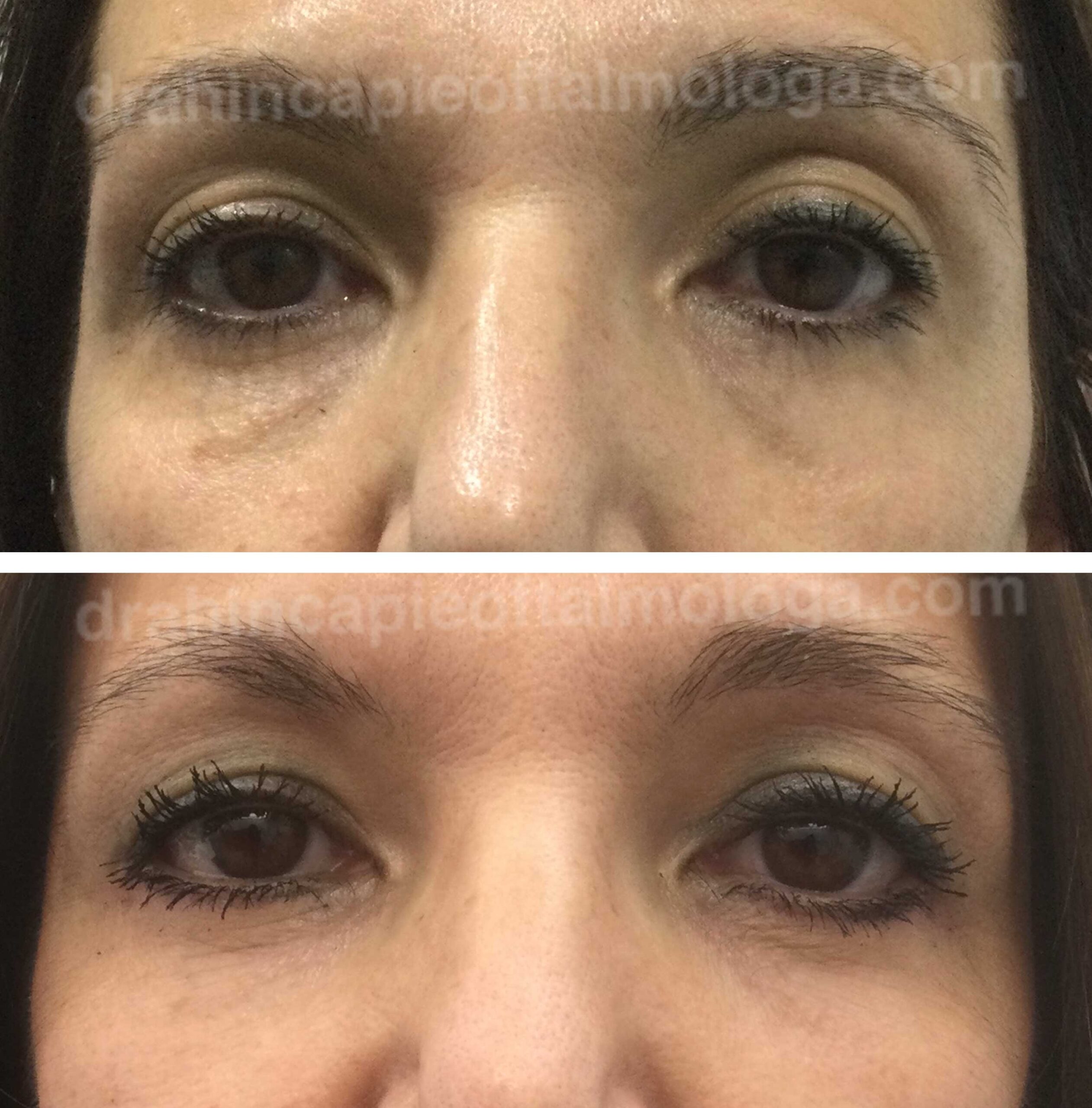 Blefaroplastia de párpado inferior con láser
