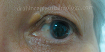 Xantelasma en párpado superior e hidrocistoma de borde libre