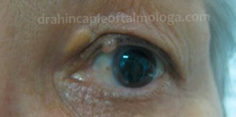 Xantelasma en párpado superior e hidrocistoma de borde libre