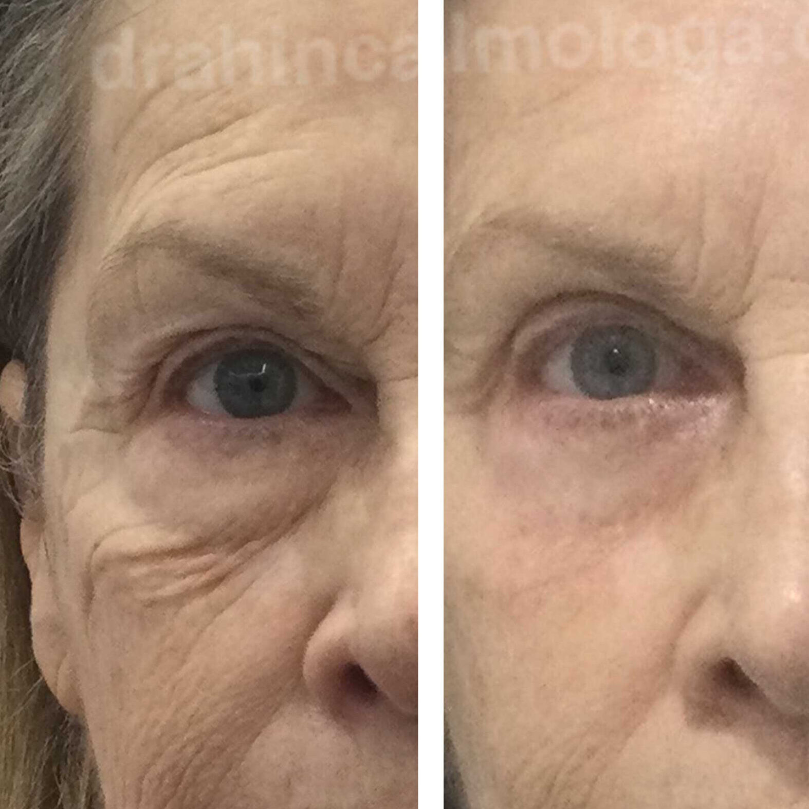 Blefaroplastia y rejuvenecimiento complementario