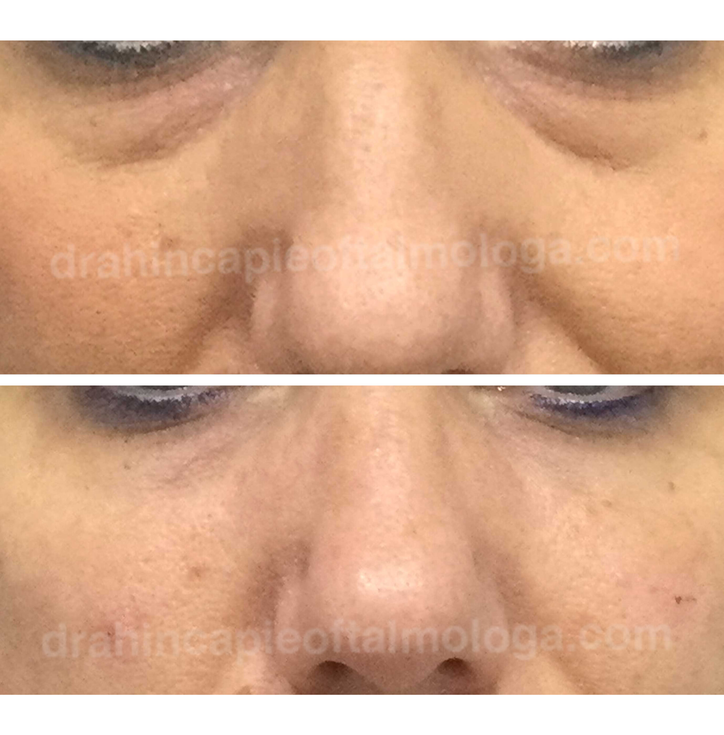 Tratamiento de bolsas y ojeras con ácido hialurónico