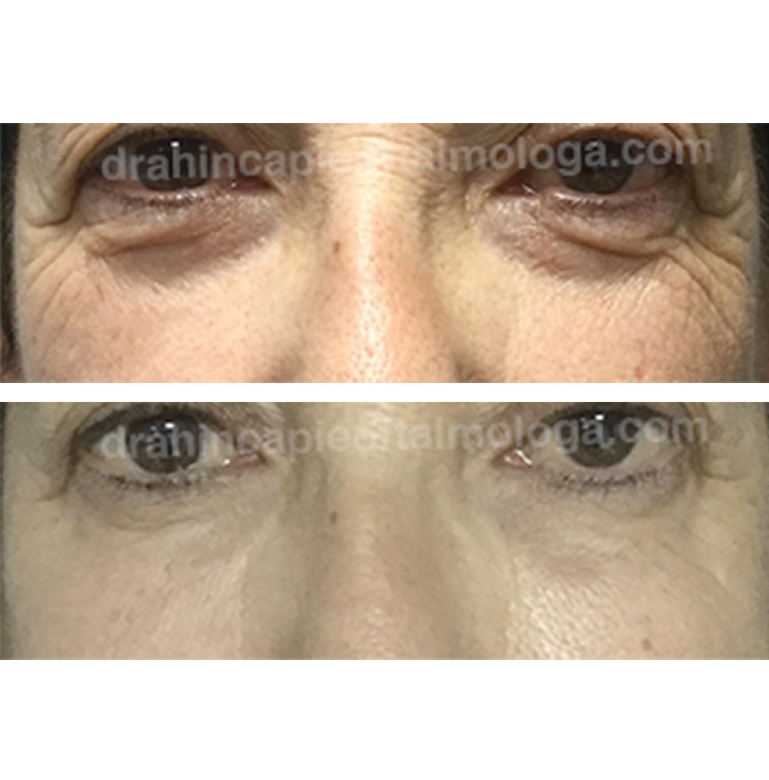 tratamiento de las bolsas de grasa y ojeras con acido hialurónico