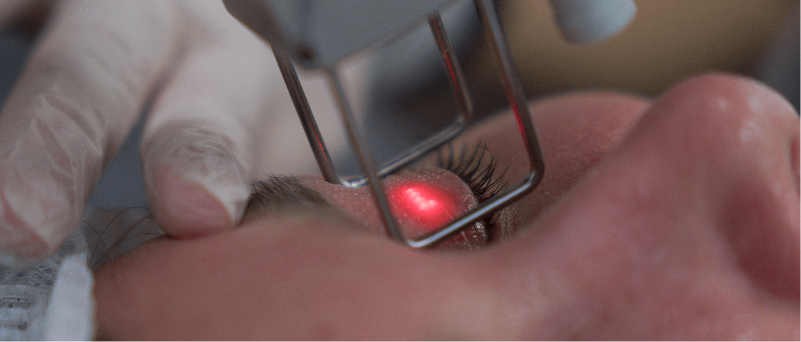 Blefaroplastia sin cirugía (Blefaroláser)